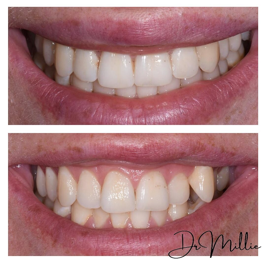 Each smile is different and we put the work in to ensure we create the perfect one for you ✨

Comment below with what you think we did here to create this result...
.
.
.

#drmillie #invisalign #invisalignbeforeandafter #smilemaker #smilemakeover #st