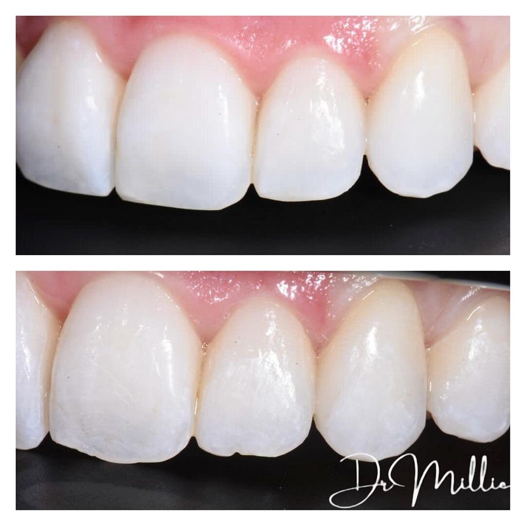 The difference a bit of composite bonding makes. ✨

#drmillie #invisalign #invisalignbeforeandafter #smilemaker #smilemakeover #straightteeth #whiteteeth #smilegoals #London #cosmeticdentist #beauty #smile #teeth #happy #smiledesign #whitening #compo