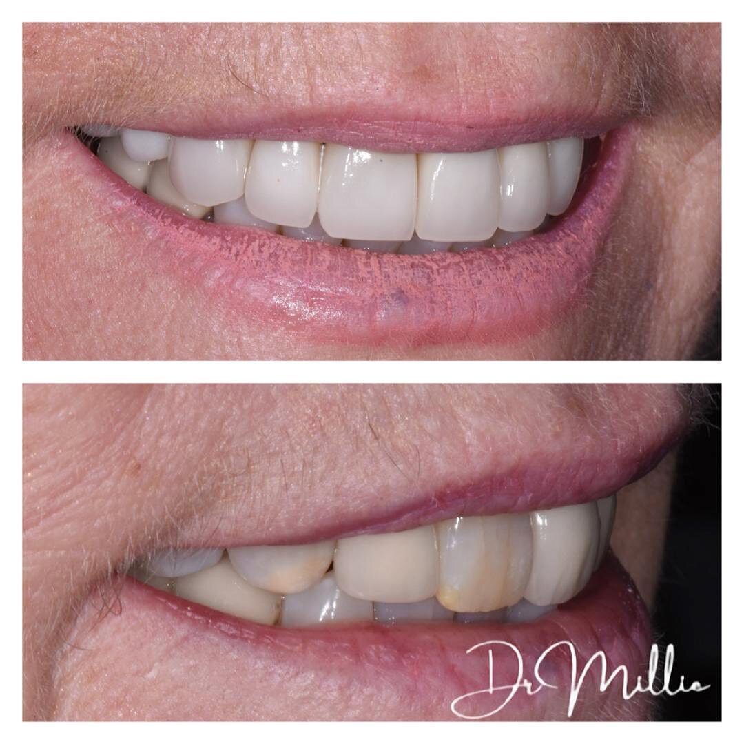 New veneers to brighten and widen this smile ✨

#drmillie #invisalign #invisalignbeforeandafter #smilemaker #smilemakeover #straightteeth #whiteteeth #smilegoals #London #cosmeticdentist #beauty #smile #teeth #happy #smiledesign #whitening #composite