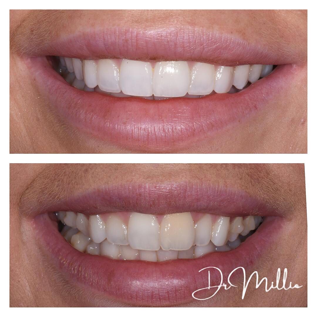 We created this wining smile with the normal trio...

-Invisalign to align
-Whitening to brighten
-Composite bonding to contour

We're thrilled with this result bringing out the natural beauty of the smile ✨

Ready to start your smile journey? DM us 