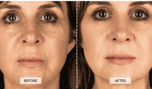 before after high frequency wand