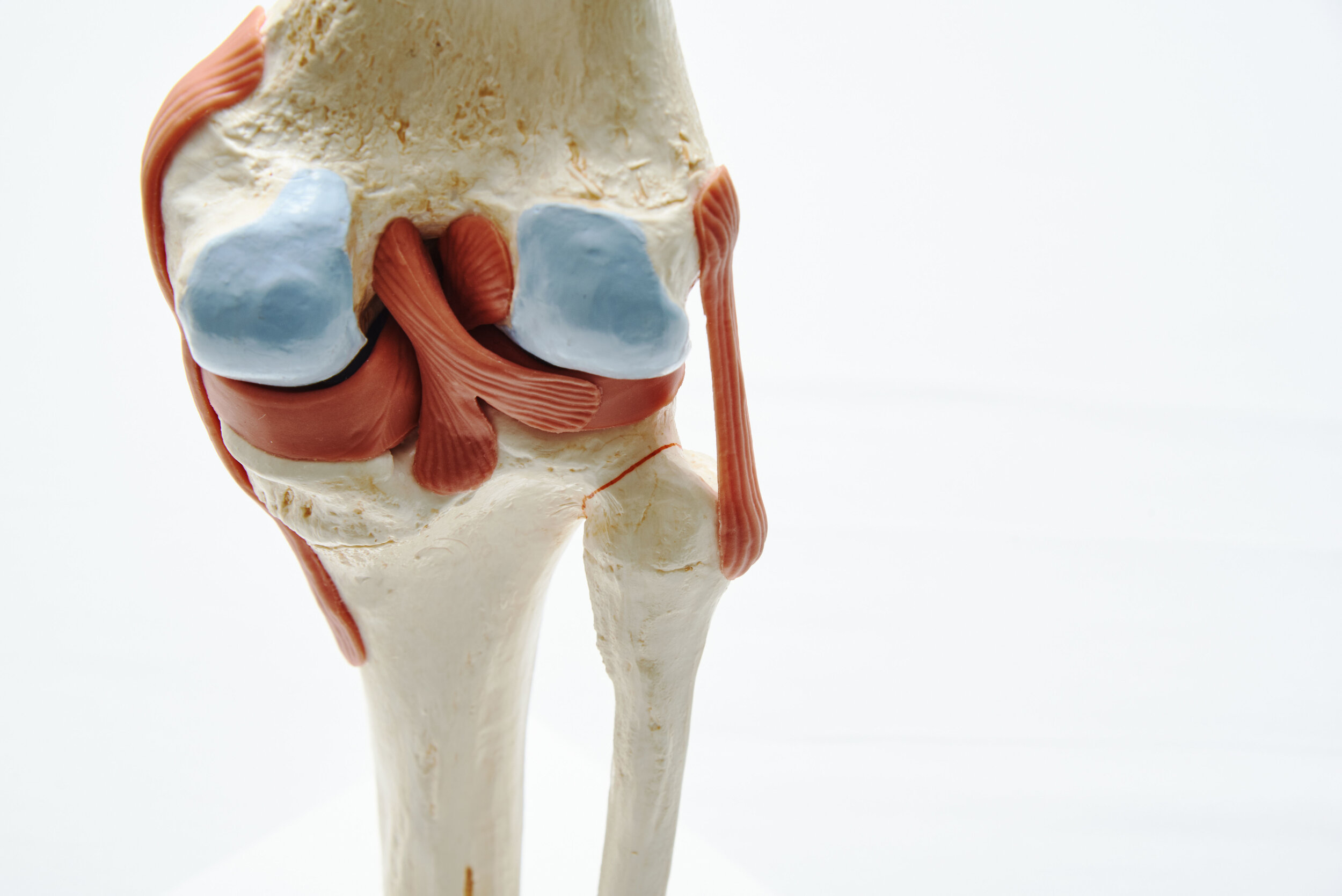 I tore both the ACL and the Meniscus. Do I need multiple surgeries? — Dr.  Bill Sterett