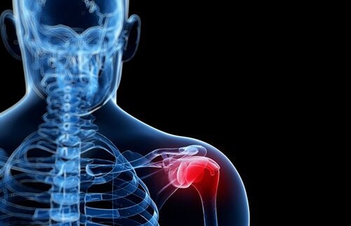 What Are the Risks of a Second Shoulder Dislocation — Dr. Bill Sterett