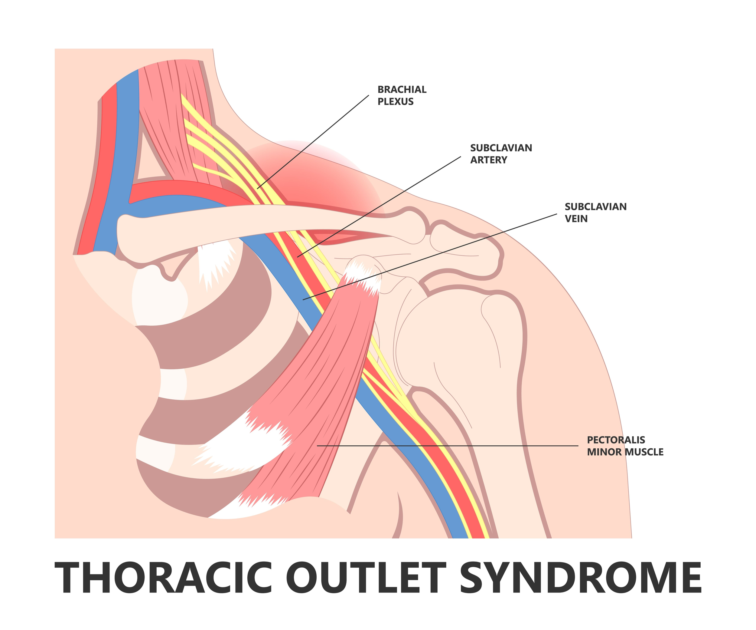 Are stretches for Thoracic Outlet Syndrome (TOS) beneficial?