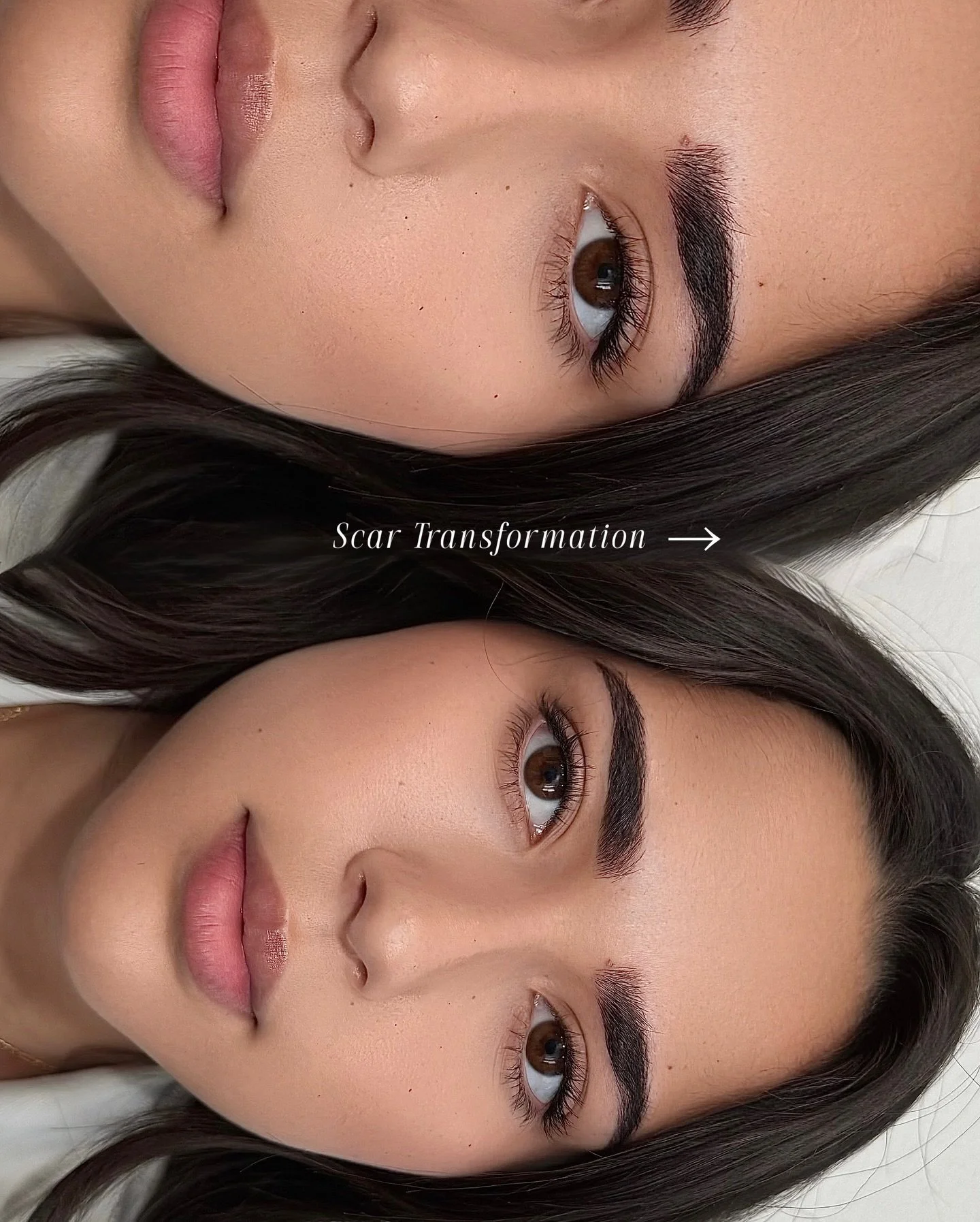 Scar Transformation using Combination technique! Notice how it gave her a subtle brow lift!