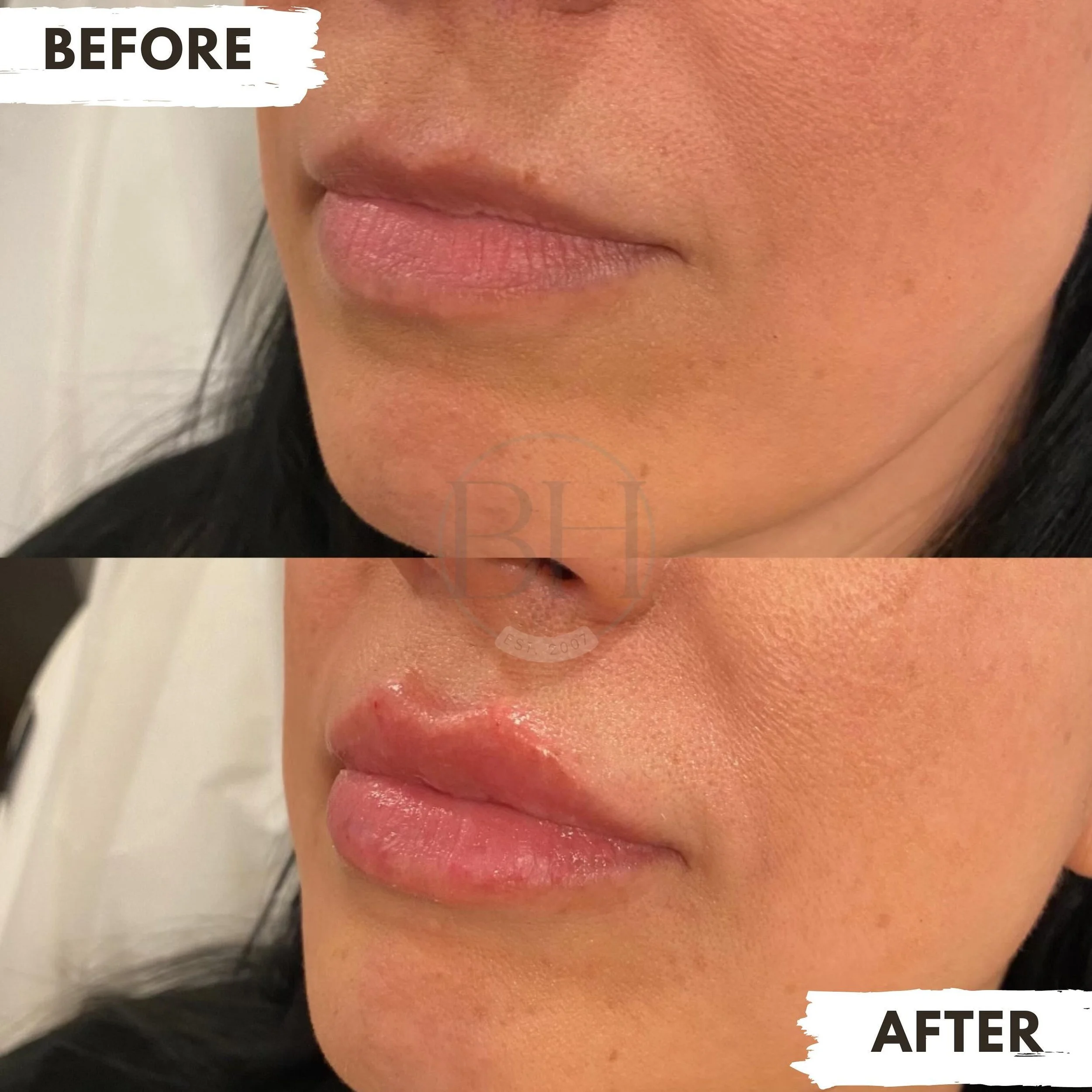 💋 💘✨🫦🌸🫶🏼💞 Interrupting your Valentine&rsquo;s Day feed to share these GORGEOUS lips done by our incredible @nurse_vivsfan !

@juvederm Vollure XC was used to achieve this beautiful shape

#valentines #valentinesday #lip #juicylips #lipfiller #