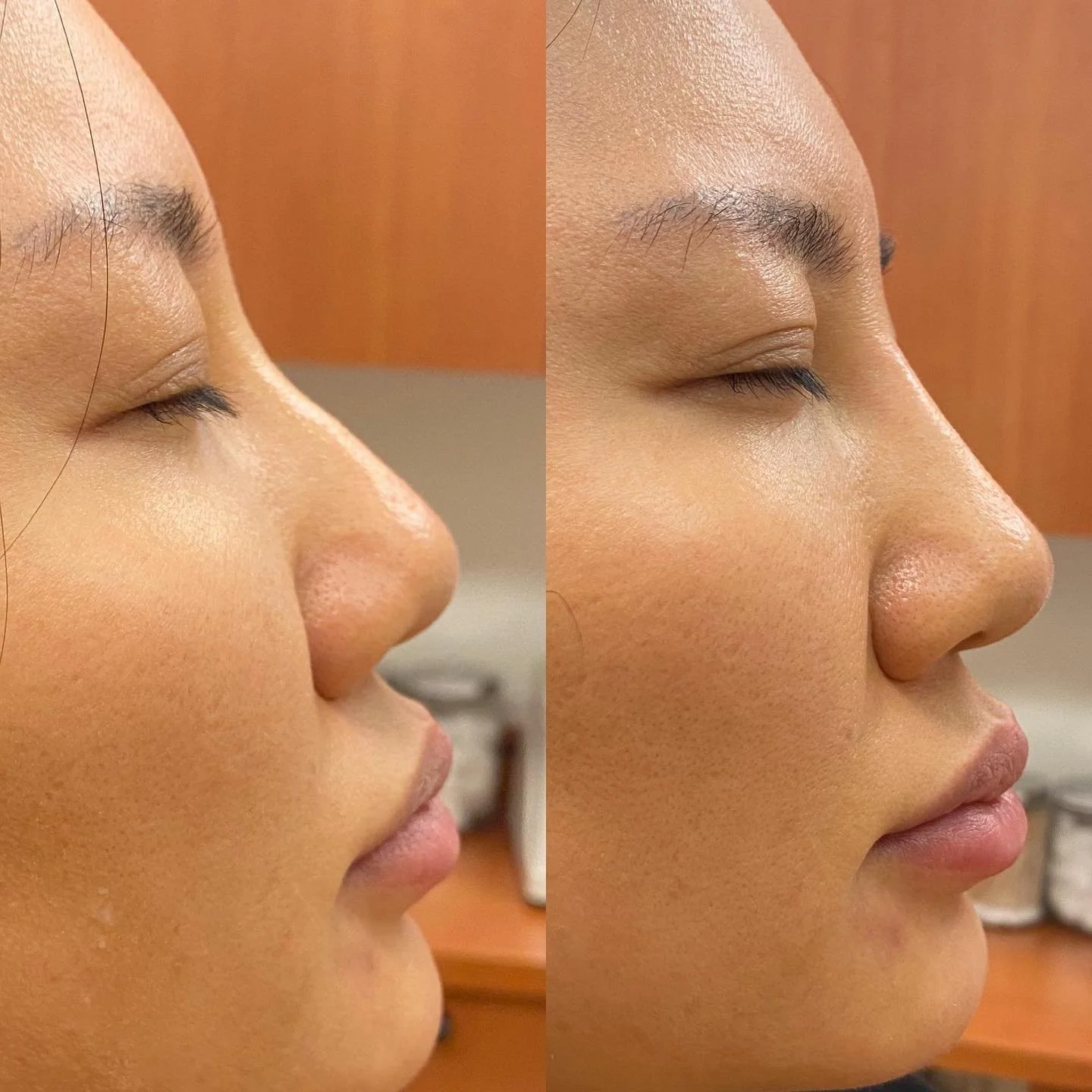 Nose filler magic 😍✨
Product: Juvederm - Volux
Nurse: @nurse_vivsfan 💉👩🏻&zwj;⚕️

Nonsurgical rhinoplasty is a cosmetic procedure where dermal fillers are used to temporarily change the shape of your nose. It&rsquo;s an alternative for those who d