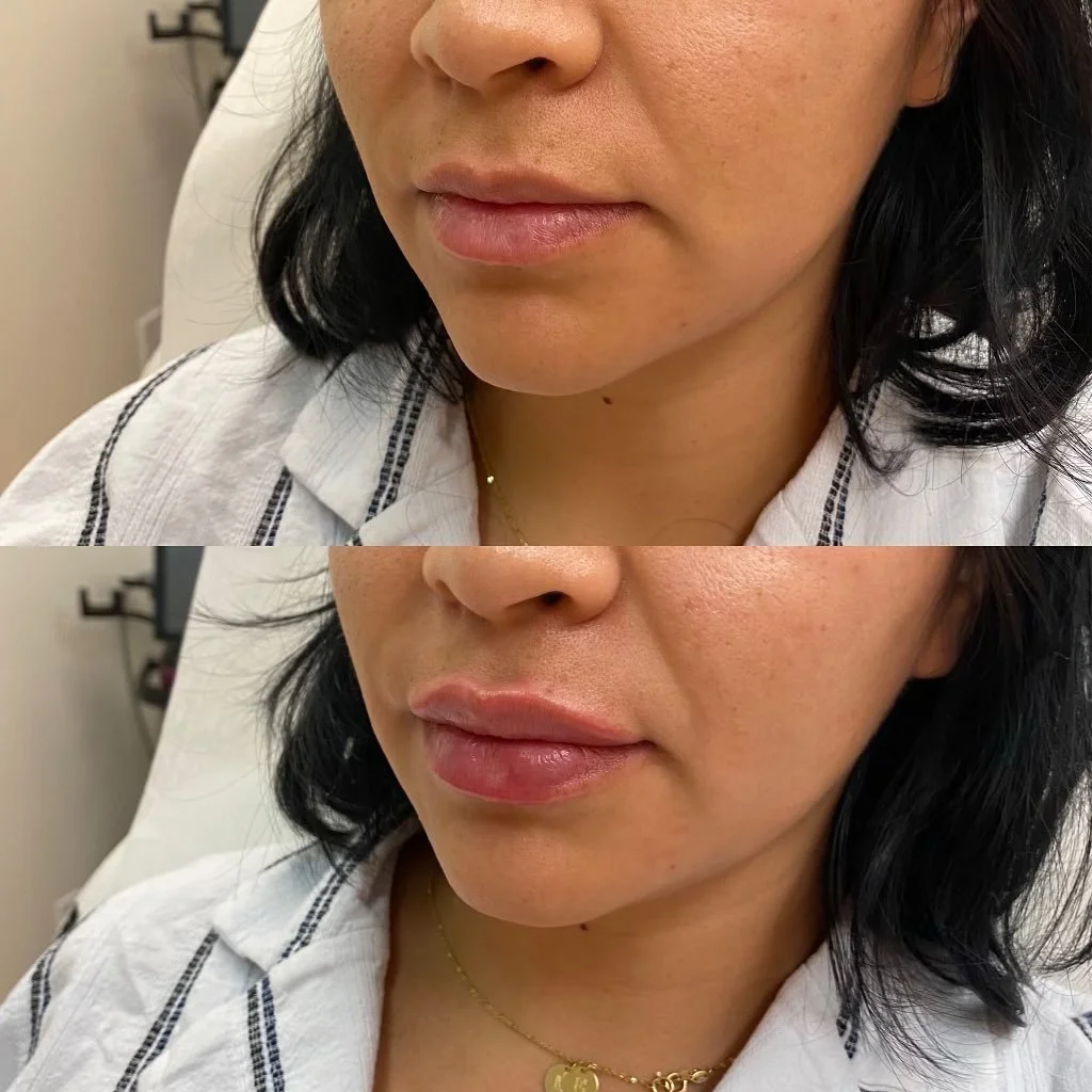 OBSESSED! Patient was treated with 1ML of volbella by @nurse_vivsfan 💉👄✨🤌🏼 

#allergan #juvederm #juvedermlips #volbella