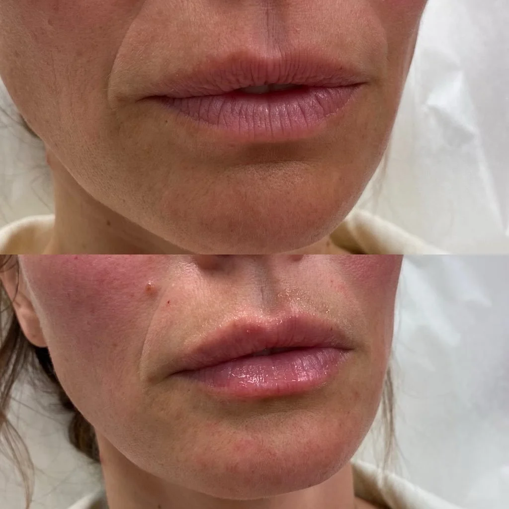 Refreshed lips 😍👄 we love to see it! 
👩🏻&zwj;⚕️- @nurse_vivsfan 

#newlips #lipfiller #lipfillerbeforeandafter #sanmarino #medspa #betterhealth