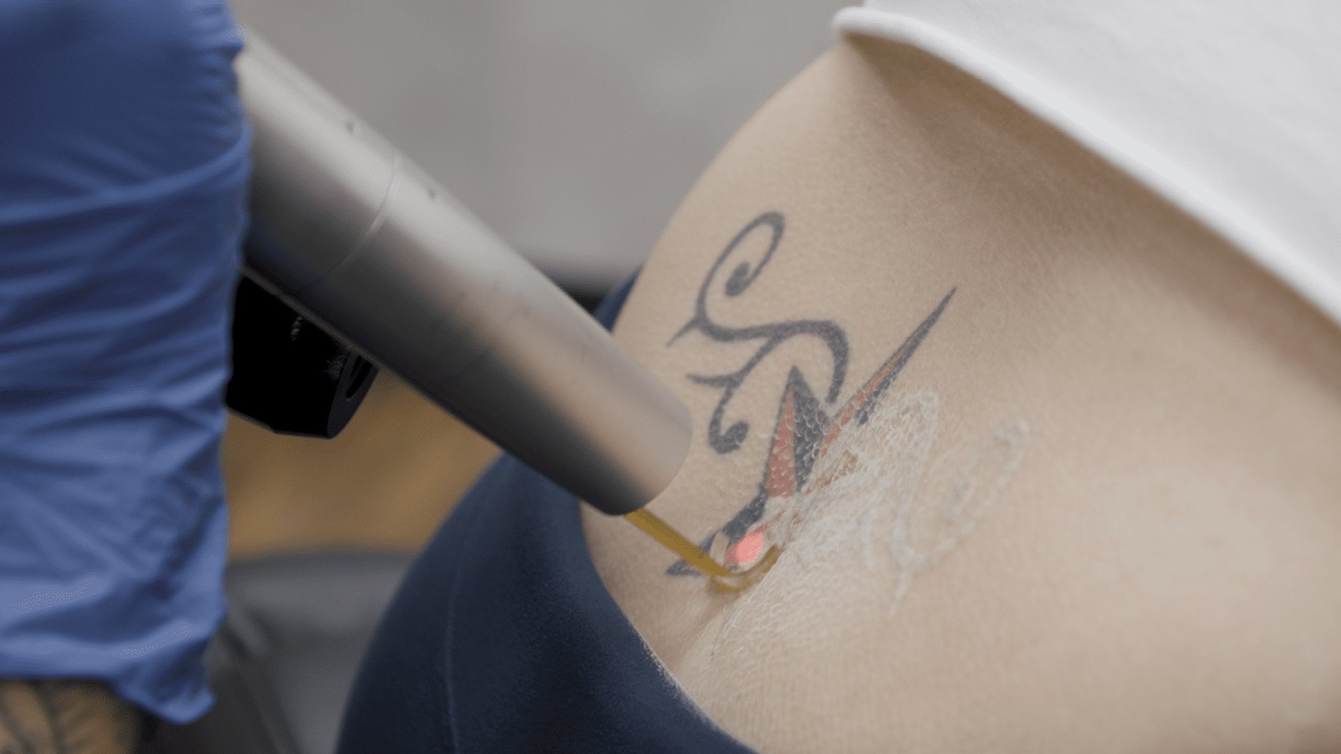Say Goodbye to Unwanted Tattoos with UnTattooU