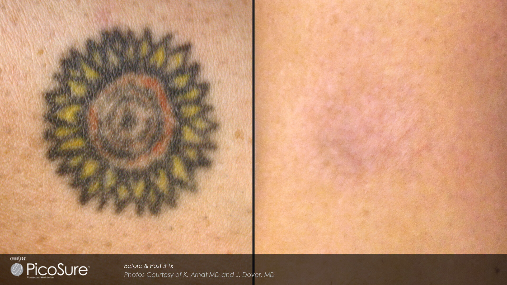 The Profitable Economics of the Tattoo Removal Industry