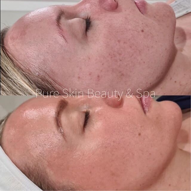 COSMELAN
Before + 2 weeks later

Who&rsquo;s been following my Cosmelan journey? Well i can tell you it has already completely transformed my skin 110% this treatment means business!

My skin is SOO much clearer, pigmentation/sunspots &amp; melasma a