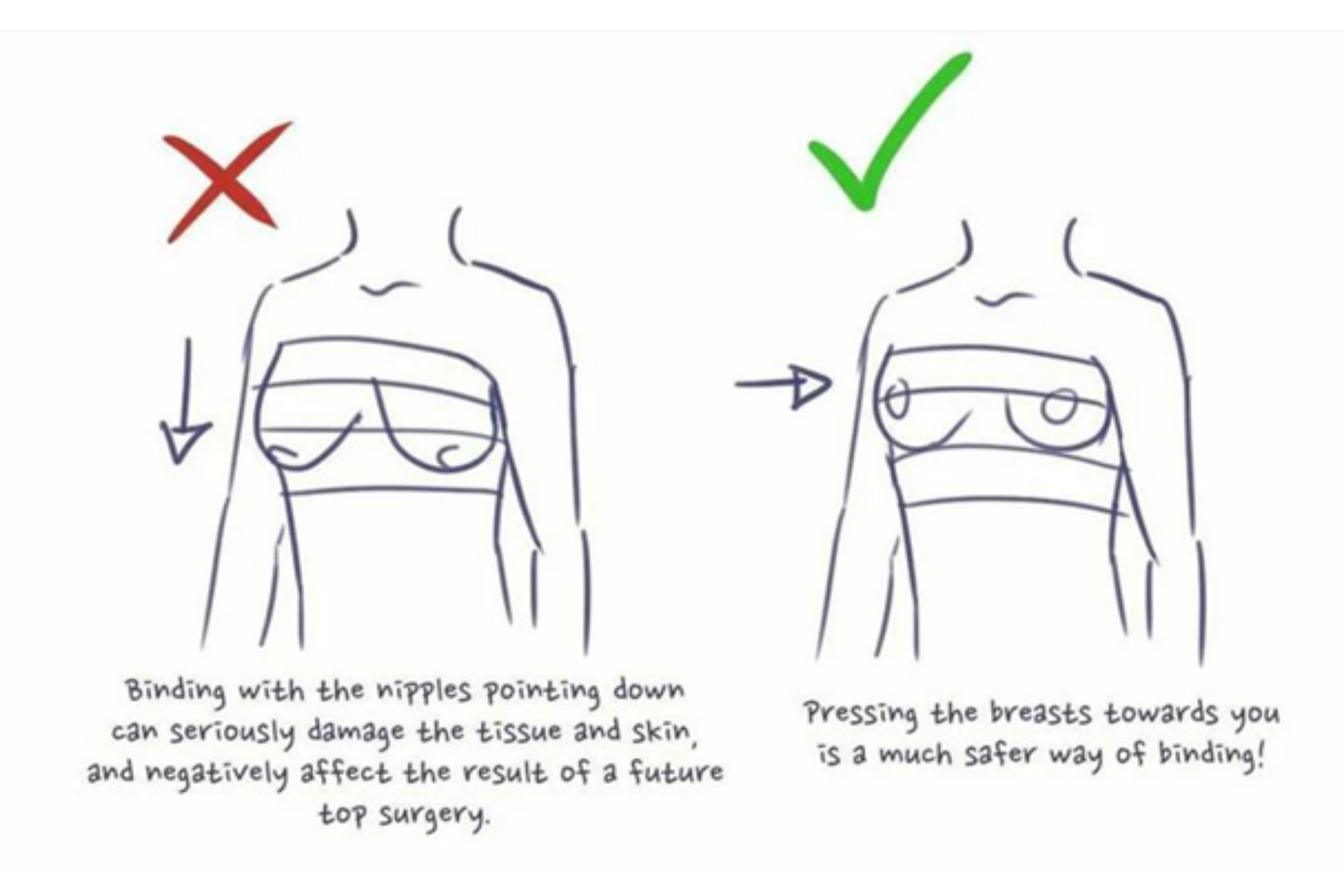 Demonstration of binding, reads, "Binding with the nipples pointing down can seriously damage the tissue and skin, and negatively affect the results of a future top surgery. Pressing the breasts toward you is a much safer way of binding!"