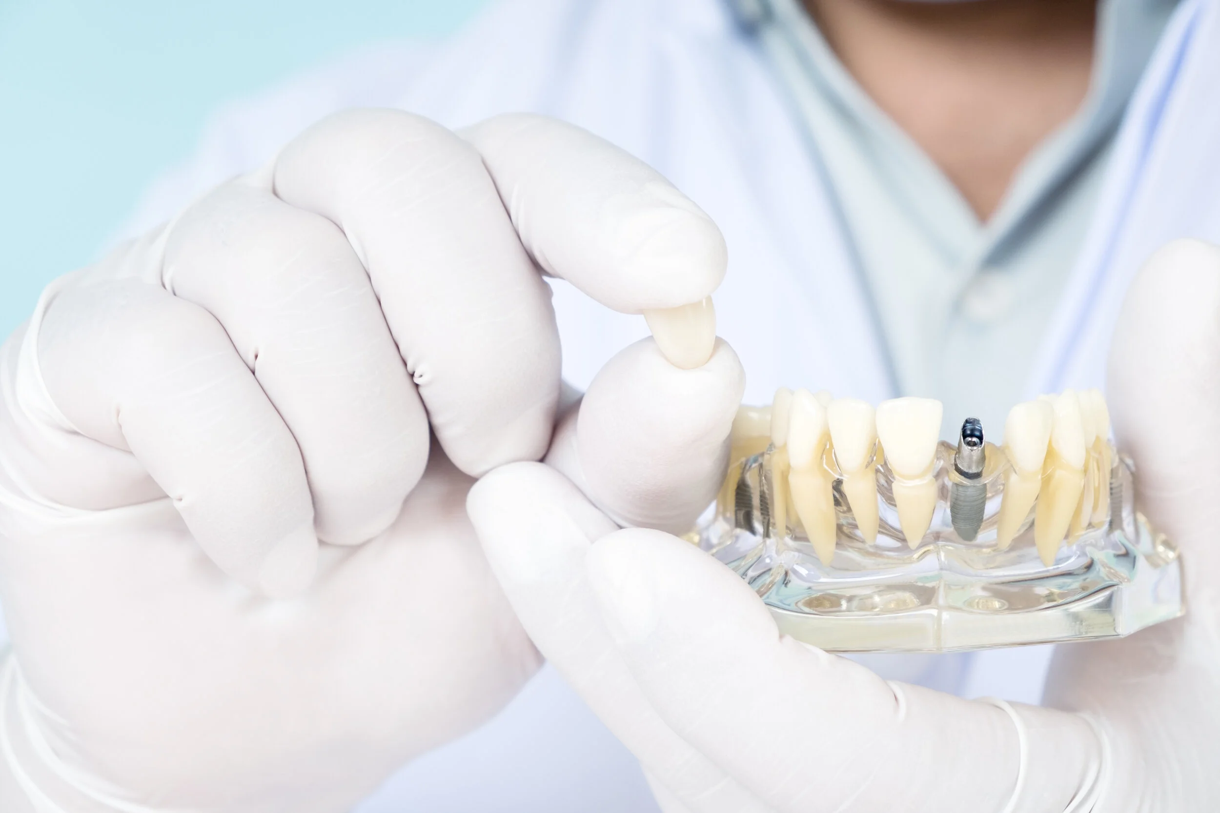 How Long Do Dental Implants Last? A Complete Guide