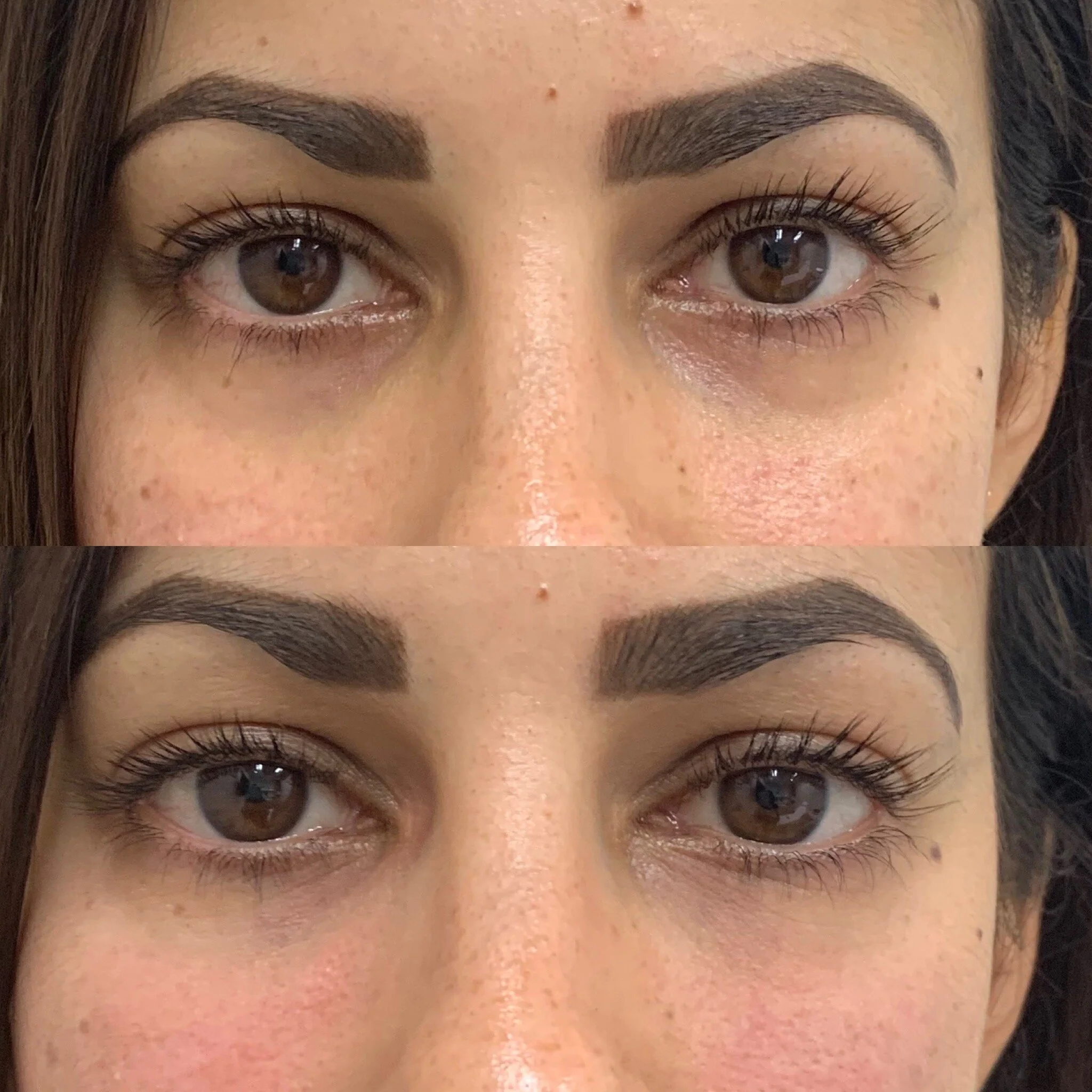 TREATMENT TO REDUCE UNDER EYE HOLLOWS    