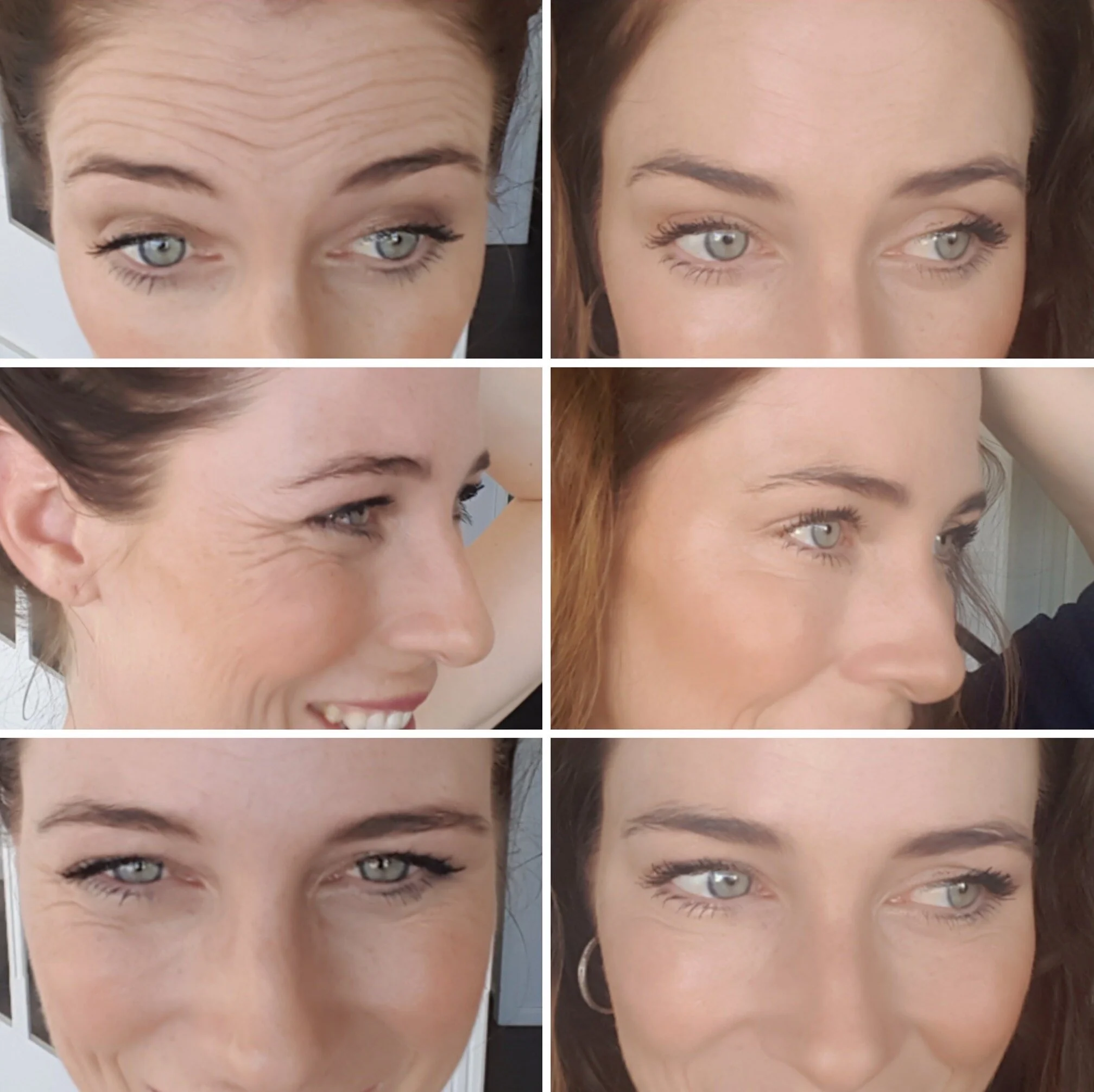 TREATMENTS TO SOFTEN WRINKLES   