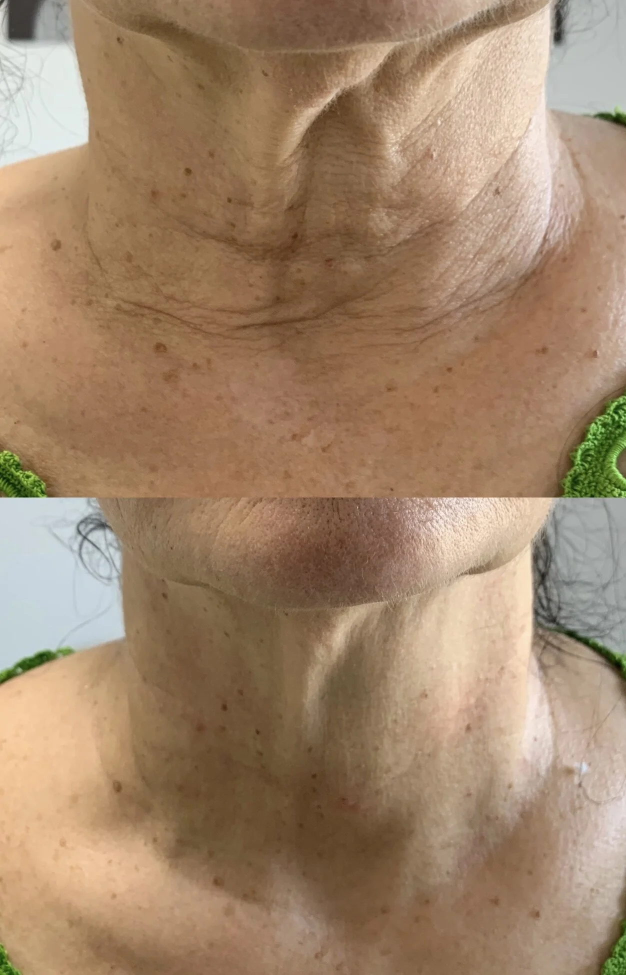 TREATMENT FOR 4D HIFU    