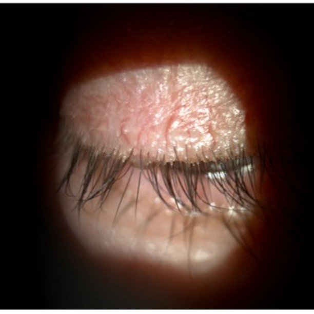 What is Blepharitis? 
Blepharitis is an inflammation along the edges of the eyelids. The eyelids can become irritated and itchy, and appear greasy and/or crusted with scales that cling to the lashes. People with blepharitis sometimes wake with their 