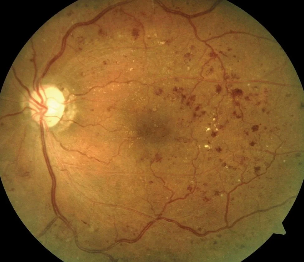 Ocular Health Exams — Glen Abbey Vision Centre