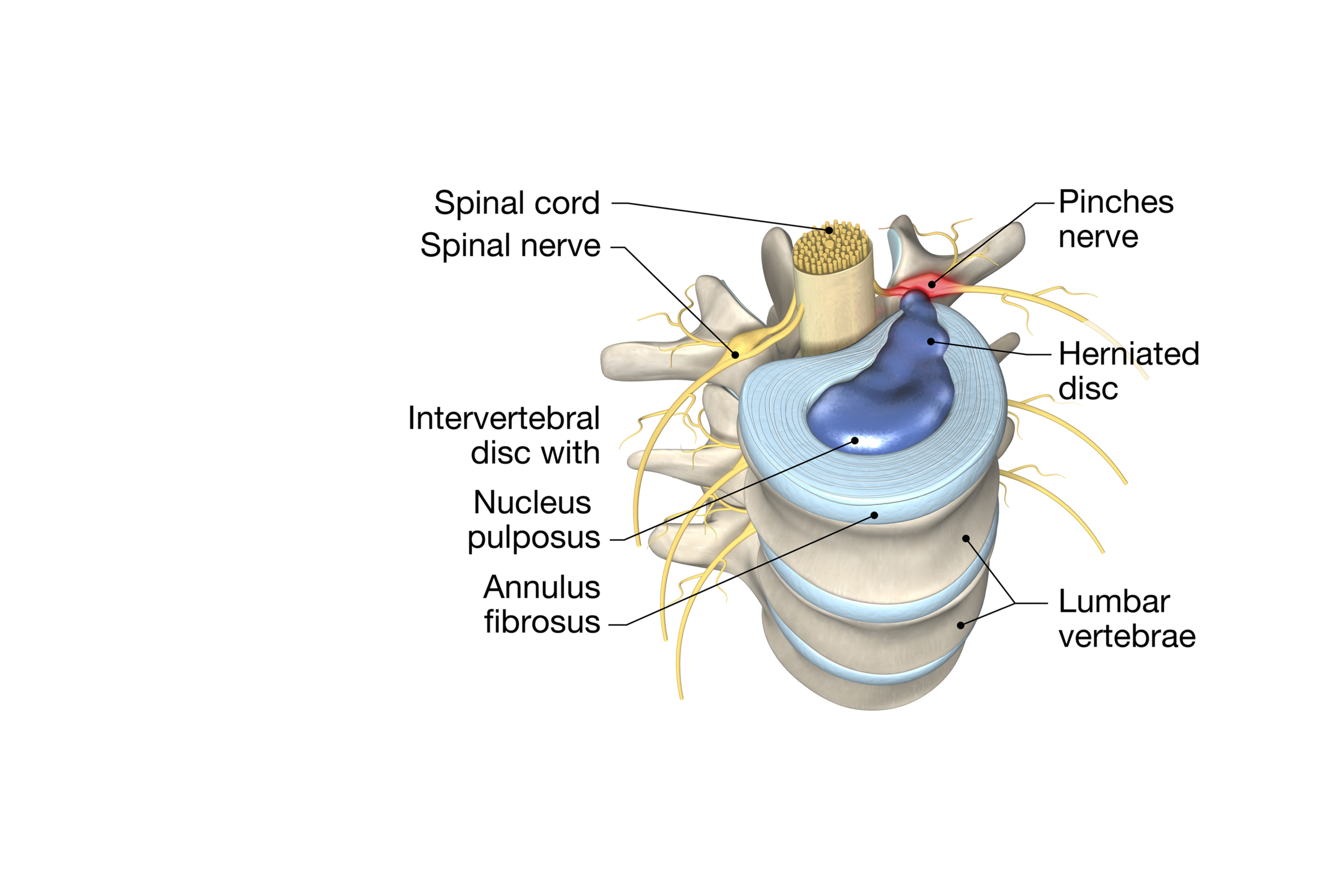 low back pain
