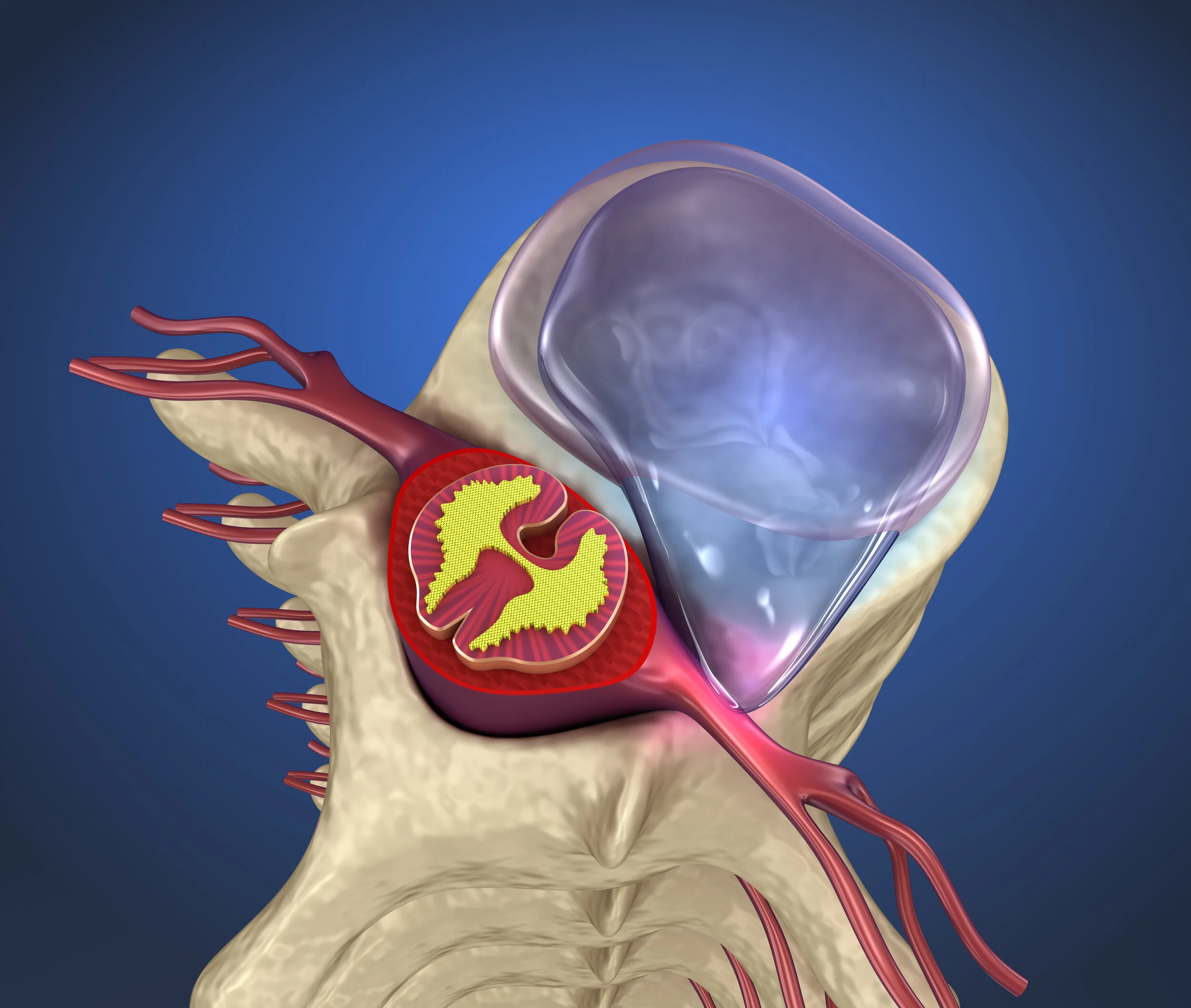 Disc herniation