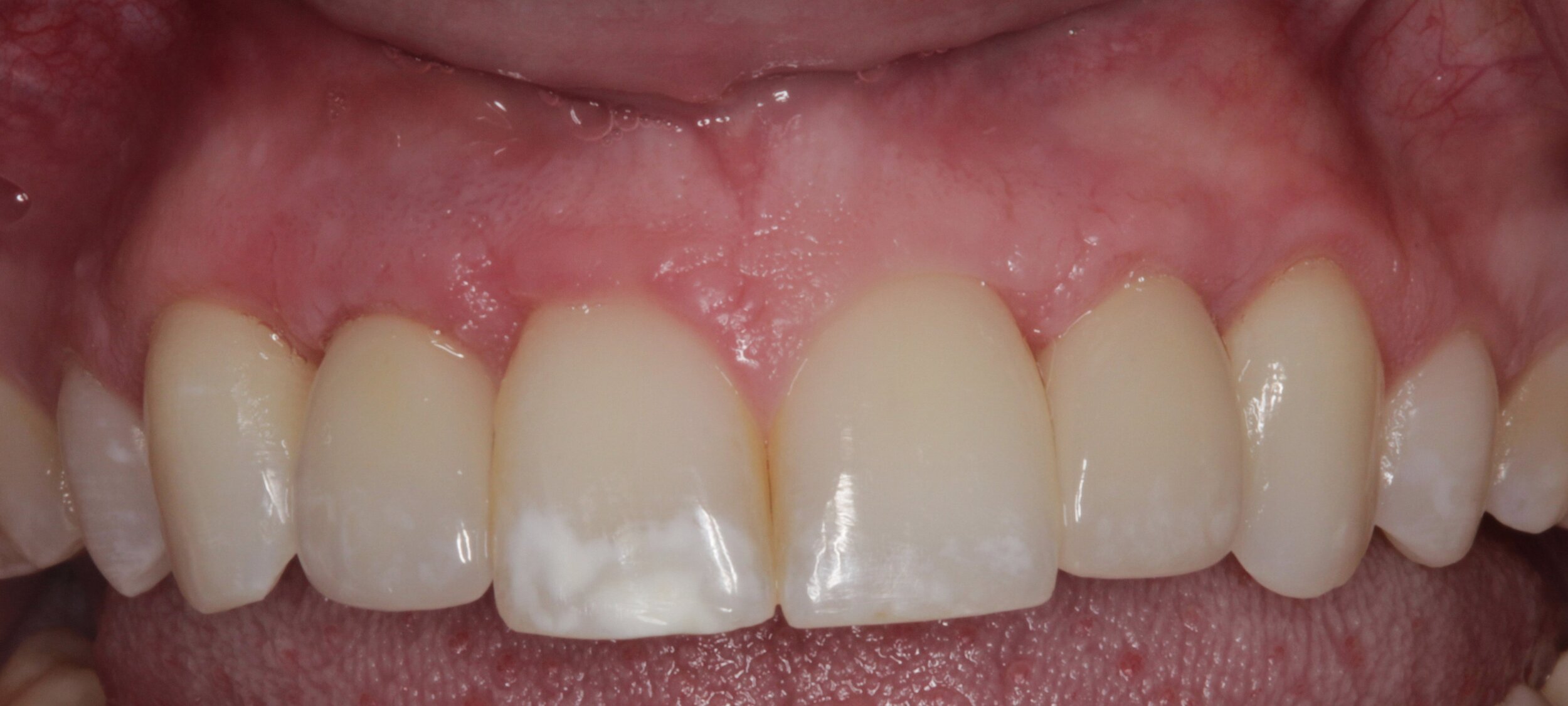 After Tooth Implant