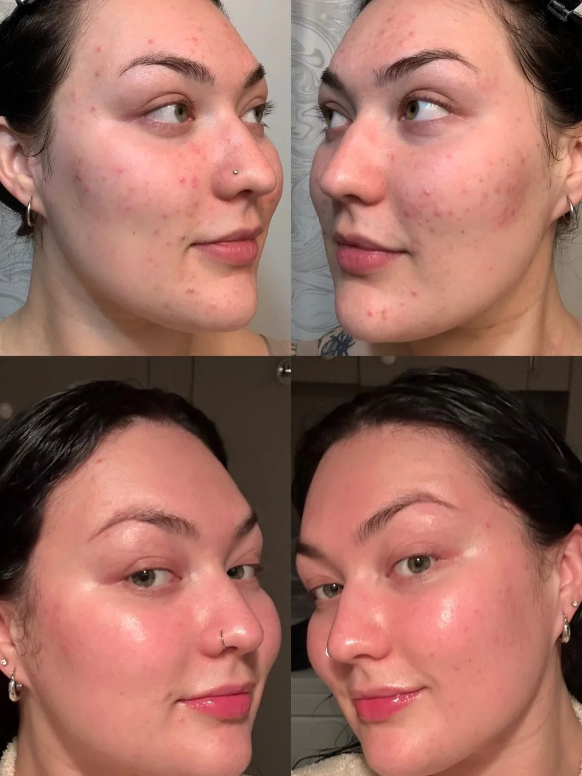 ✨ Real skin. Real results. ✨

Over the past year, her skin has completely transformed &mdash; calmer, clearer, and more balanced 🤍
One consistent staple in her routine? Huna Blemish Control Serum by Huna 🌿

Gentle enough for long-term use, powerful