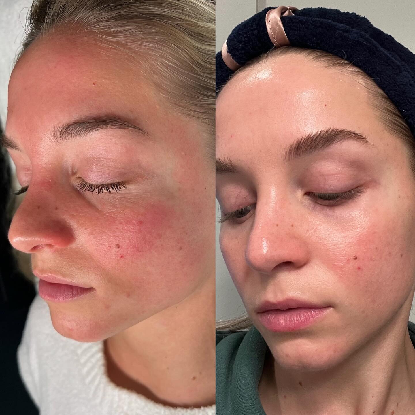 Bye Bye Rosacea ✌🏼

Her routine:
⭐️Ultra gentle cleanser
⭐️Exfoliating peel pads
⭐️Mystro- #1 product for rosacea 
⭐️Even tone correcting serum
⭐️Trio Rebalancing moisture treatment 
⭐️SPF 70 sheer
⭐️Sulfur spot treatment as needed 
⭐️Face reality s