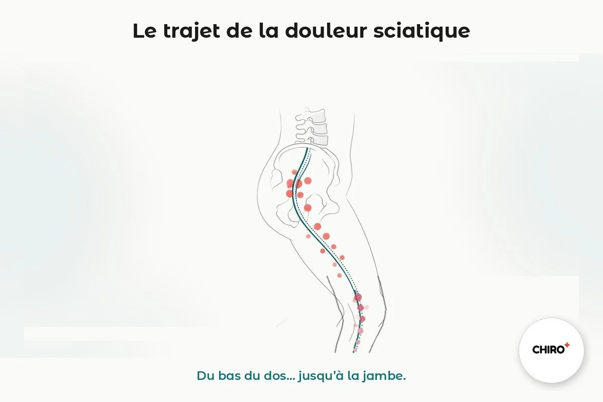 Illustration du trajet de la douleur sciatique du bas du dos jusqu’à la jambe