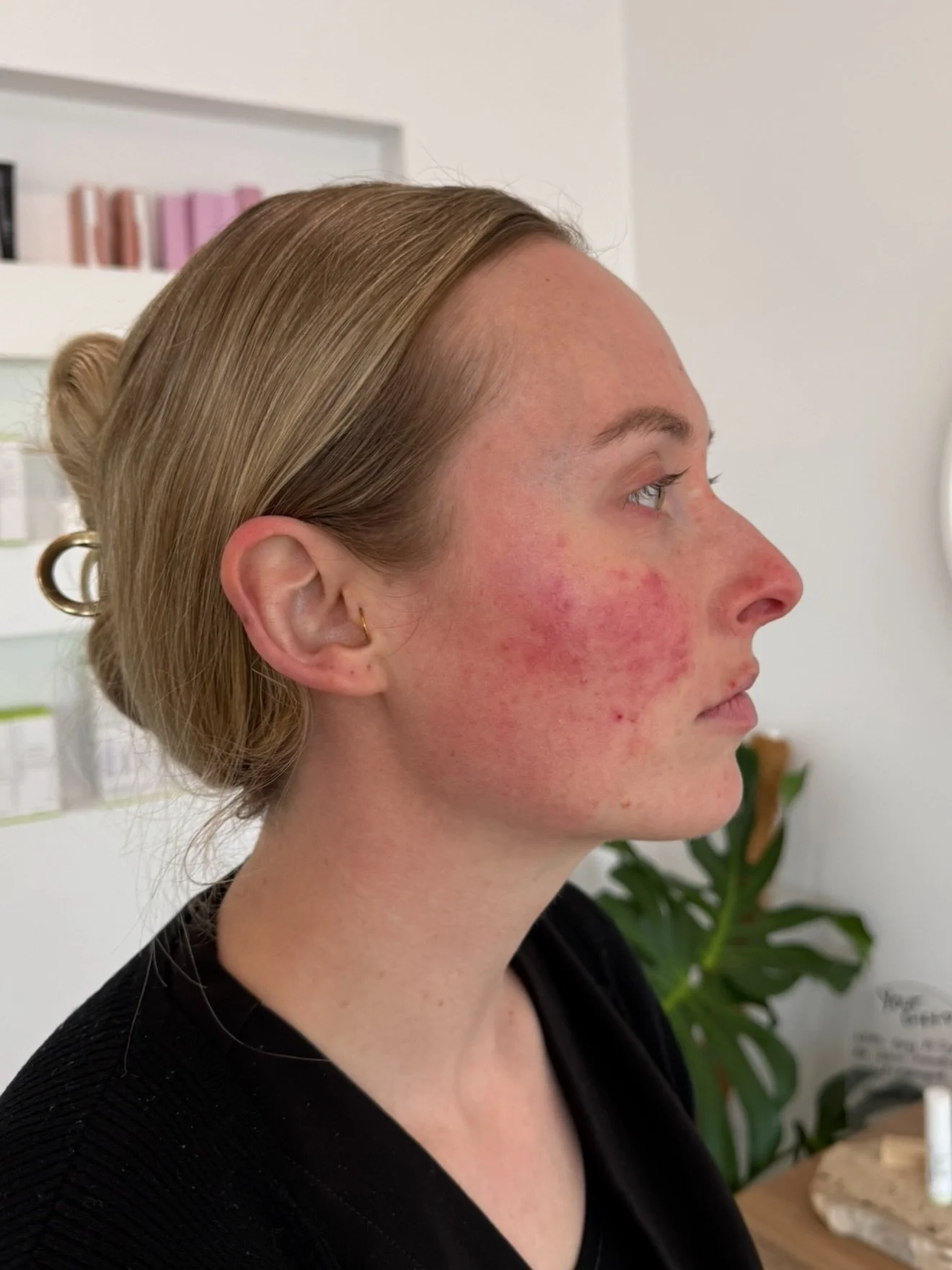 Before and After of our beautiful Lanah!

Her concerns were redness, acne and rosacea.
She had a course of x3 dermapen spaced approximately 6 weeks apart.
Her home care regime consisted of our ultra balancing gel cleanser, a perfecting serum, c serum