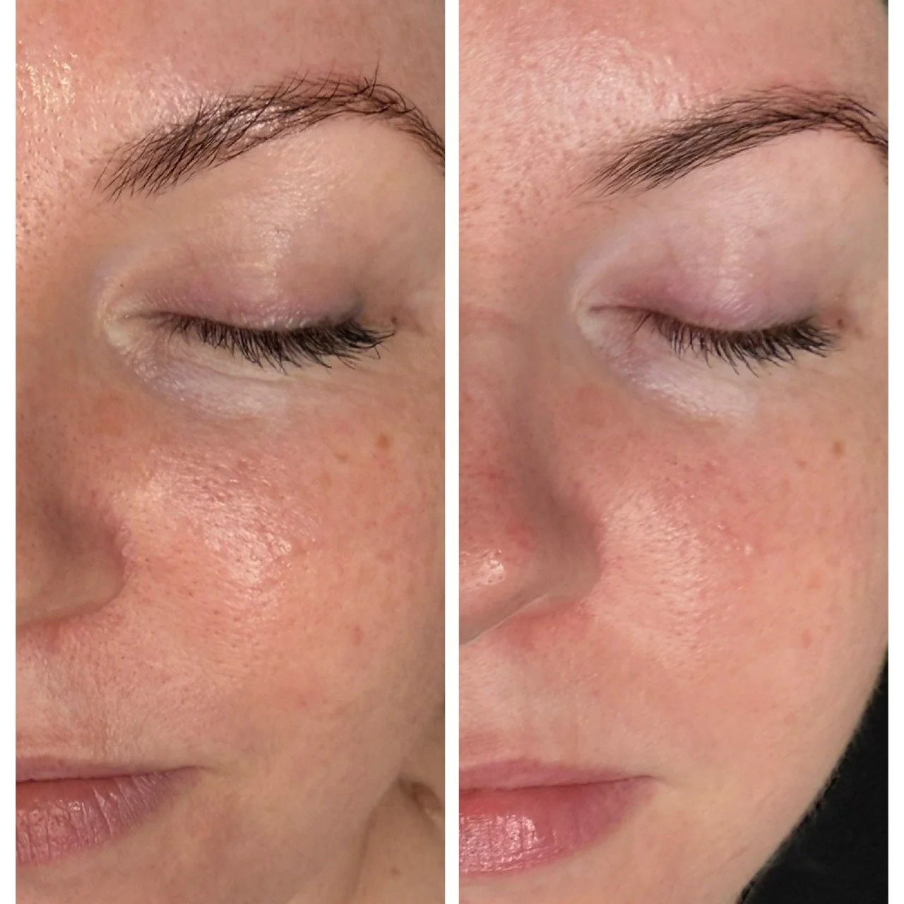 Skin needling with exosomes!

Before and 3weeks After 😍

We were treating for uneven skin texture/skin tone, pigmenation as well as rejuventation
The skin will keep renewing &amp; restoring over the next few weeks.
Exosomes  used with skin needling 