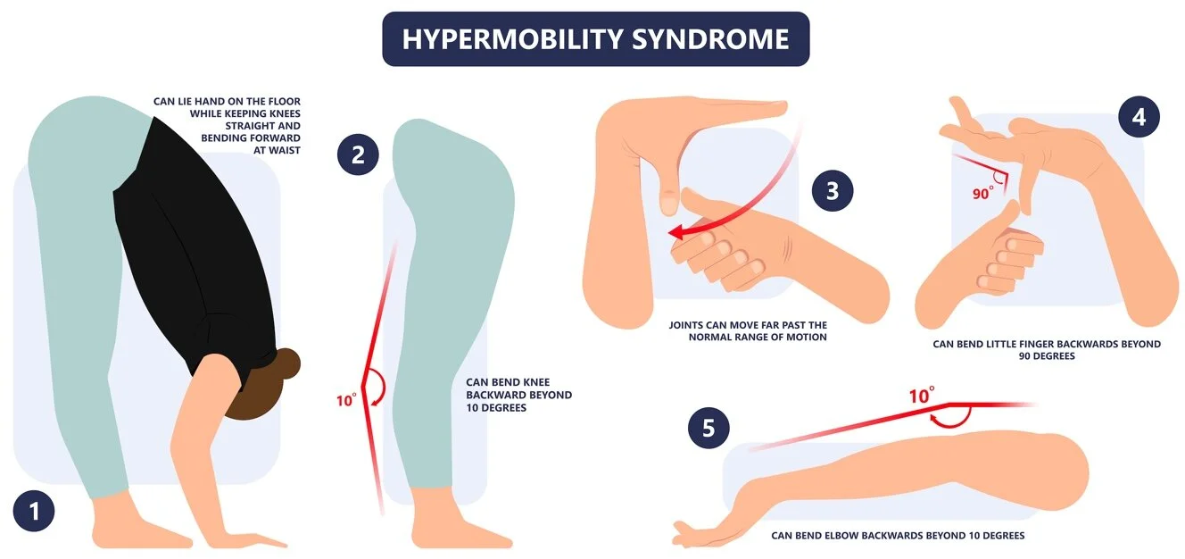 Living with Joint Hypermobility — CRC Physical Therapy and Wellness