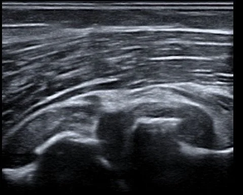 Imagen de una ecografía en blanco y negro mostrando un embarazo en desarrollo.