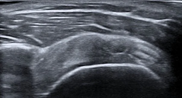 Imagen de una ecografía médica en tonos grises.