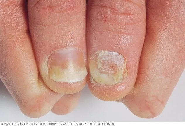 Dedo con uñas afectadas por psoriasis o infección, con áreas amarillas y dañadas
