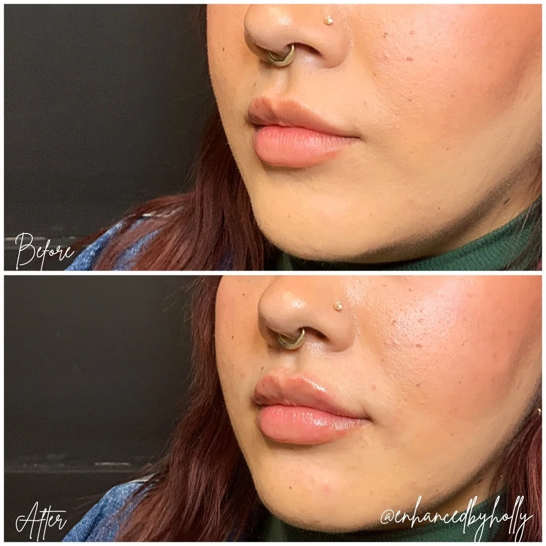 Lips ✨.
.
This 1/2 syringe is soft, balanced, and beautifully natural 💋✨ Lip filler isn&rsquo;t about changing your features&mdash;it&rsquo;s about enhancing what&rsquo;s already there. Subtle volume, improved shape, and confidence from every angle.