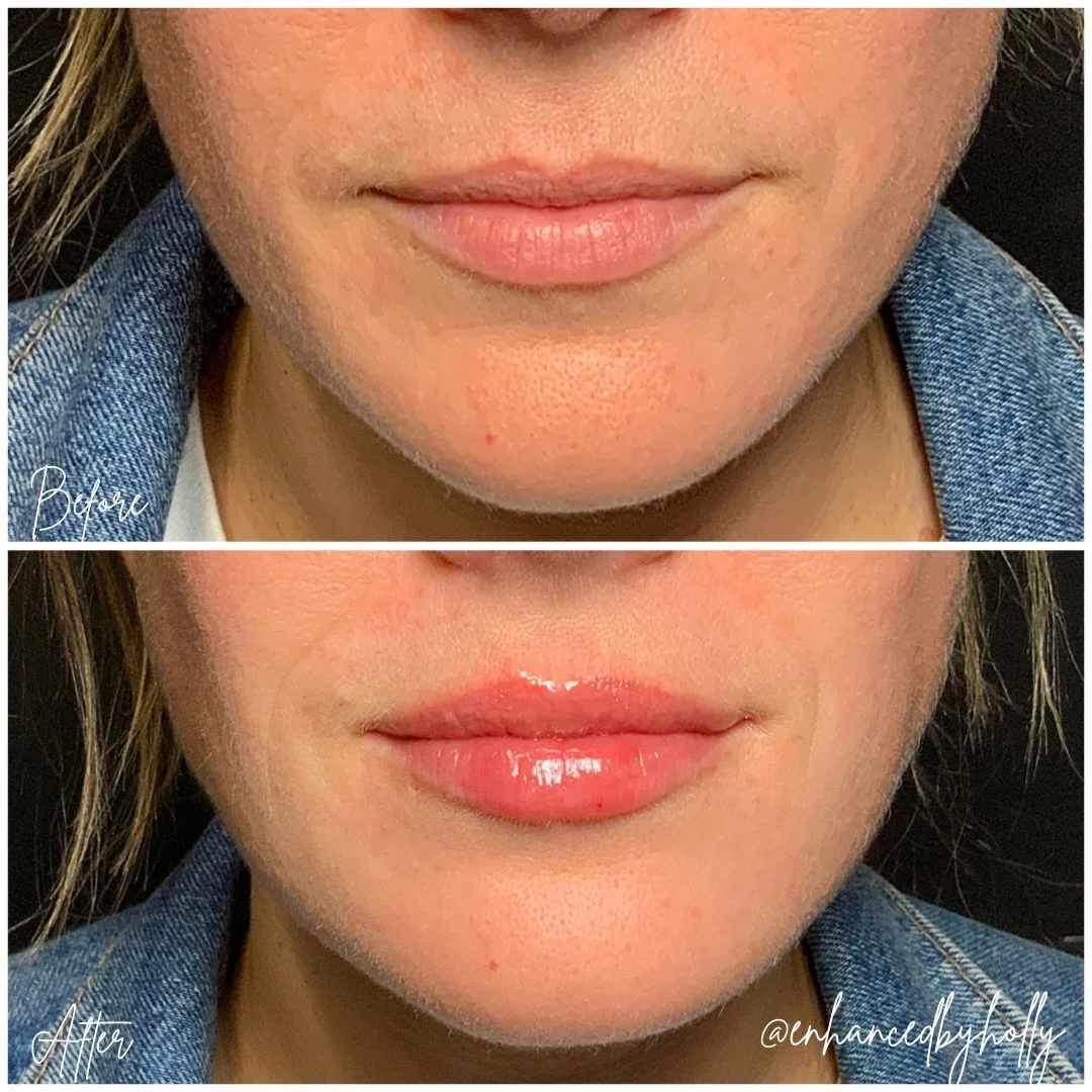 Lips 💋.
.
A little lip filler can make a big difference&mdash;adding subtle volume, definition, and balance while still looking like you is always what I&rsquo;m after! Natural-looking results are always the goal, creating soft, hydrated lips that e