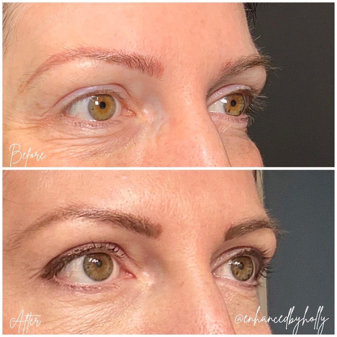 Eyes ✨.
.
Eye tox is one of the most underrated treatments for a brighter, more refreshed look 🎉 By softening crows feet, it helps reduce fine lines and wrinkles while opening up the eye area for a more rested appearance. A subtle treatment that can