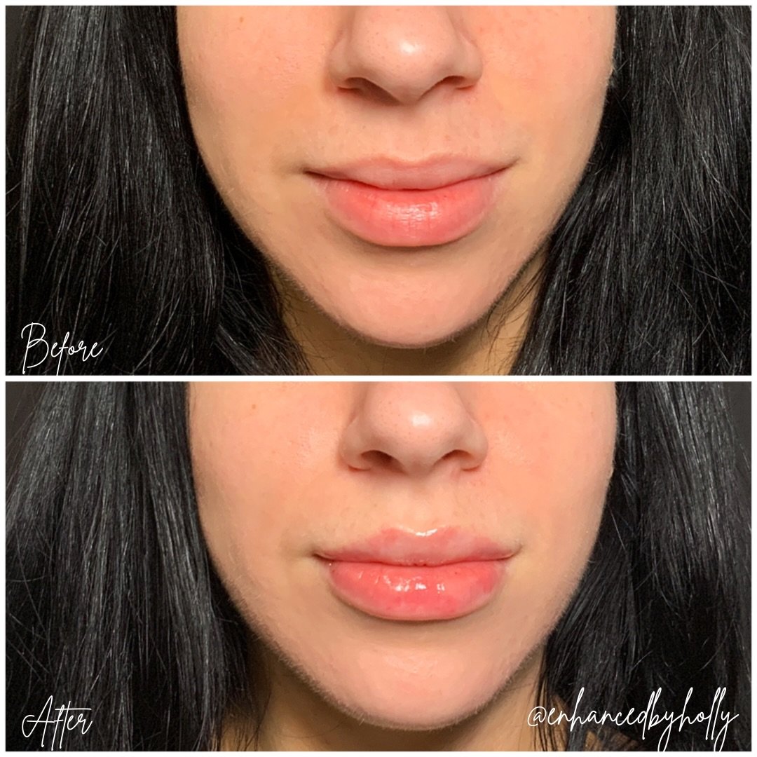 💋 Lip filler isn&rsquo;t about creating the biggest lips possible&mdash;it&rsquo;s about creating balance, shape, and beautiful proportions that fit your face.

For this client, our goal was soft enhancement with a focus on structure, hydration, and