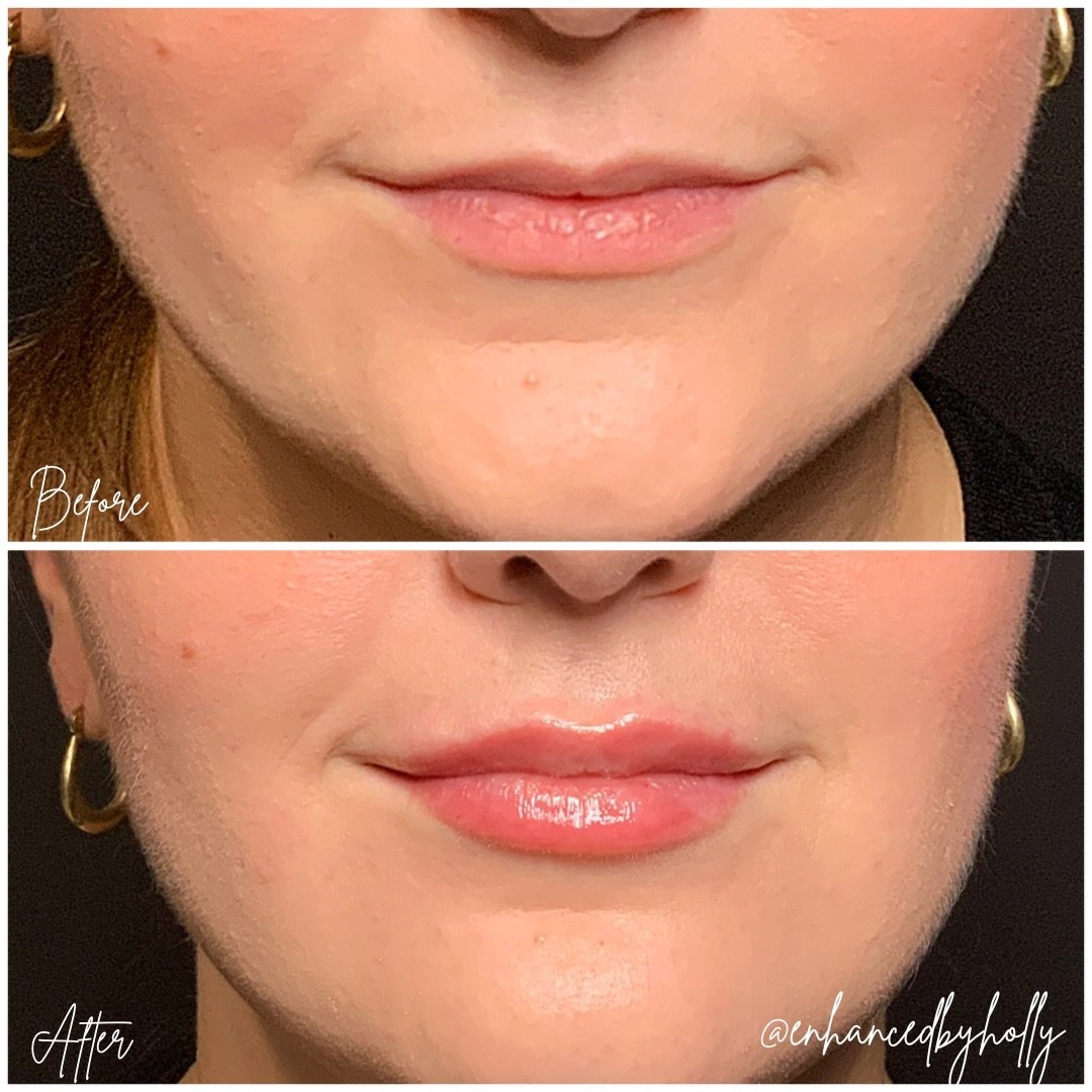 A Natural Lip Transformation ✨.
.
A little balance, a little hydration, and a little enhancement can go a long way. ✨ My goal is never to create &ldquo;overfilled&rdquo; lips&mdash;it&rsquo;s to enhance your natural features while keeping your result