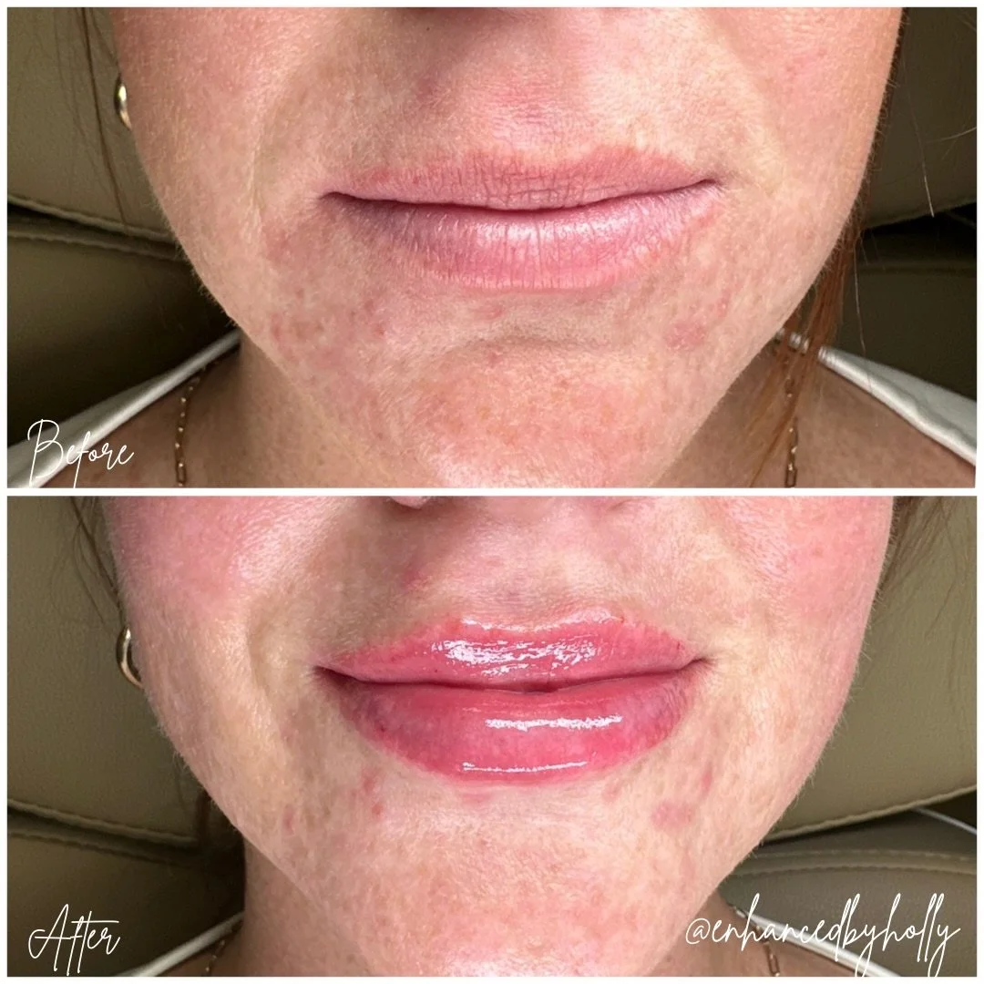 Natural Lips, Just Enhanced 💋

A little filler can go a long way 🤍 Subtle volume, beautiful definition, and a result that still looks like you. ✨

👸🏻Client Consent for sharing received.
💆🏻&zwj;♀️Treatment: Lip Augmentation.
🦄 Product: Hyaluron