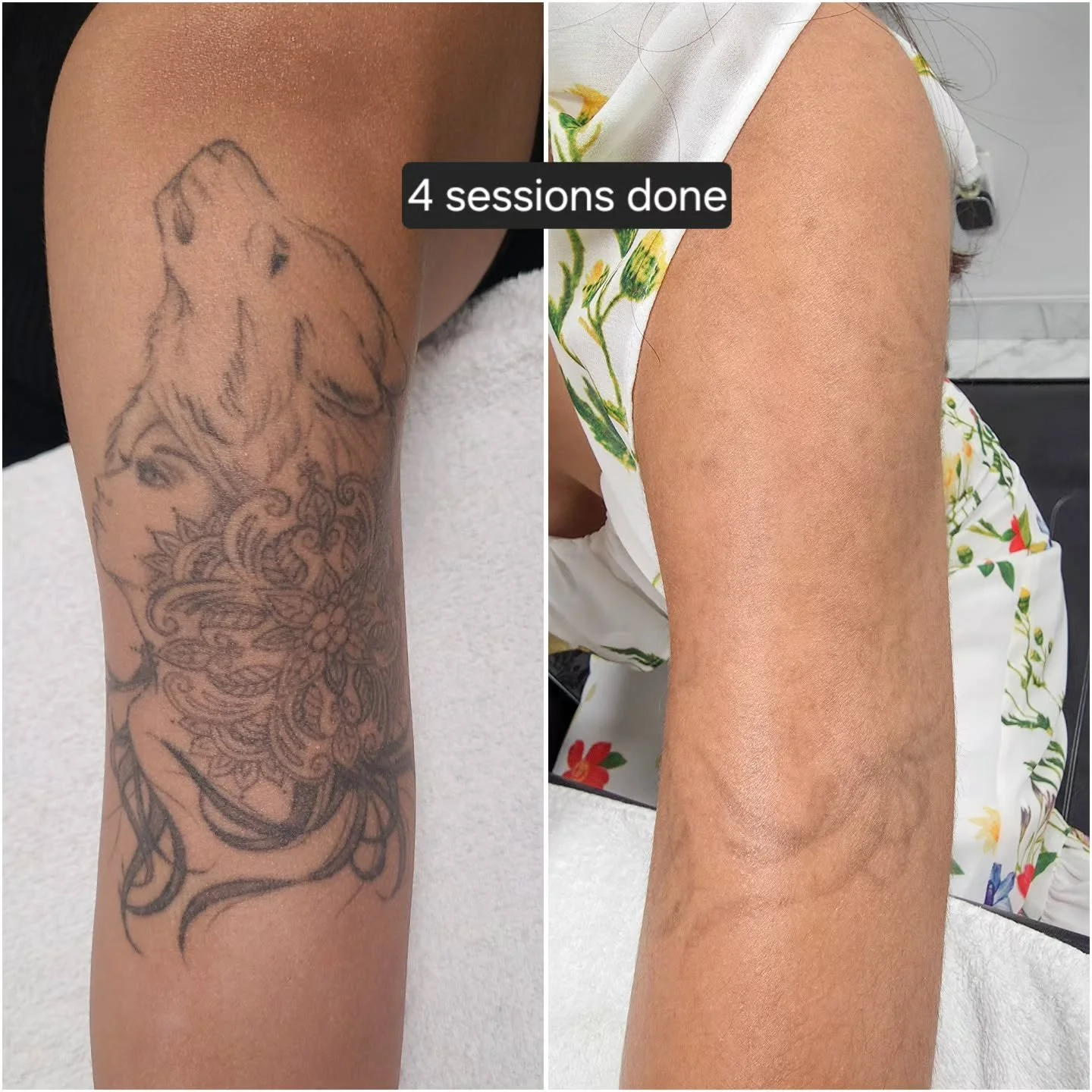 Great progress here! Everyone's body works differently, and results can vary depending on how strong a person's immune system is, the style/ink used, how healthy of a lifestyle a person lives...etc.

For any questions or inquiries free feel to DM. Th