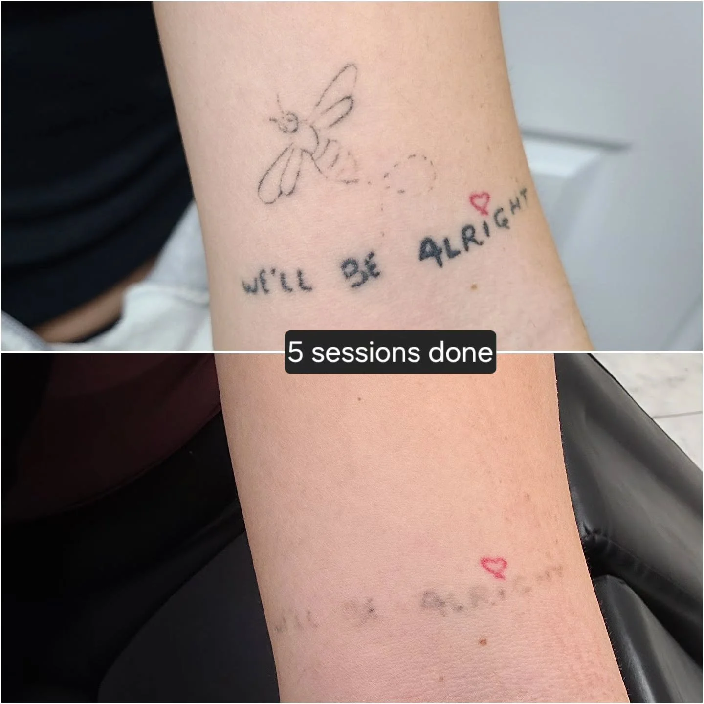 Great progress here! Everyone's body works differently, and results can vary depending on how strong a person's immune system is, the style/ink used, how healthy of a lifestyle a person lives...etc.

For any questions or inquiries free feel to DM. Th