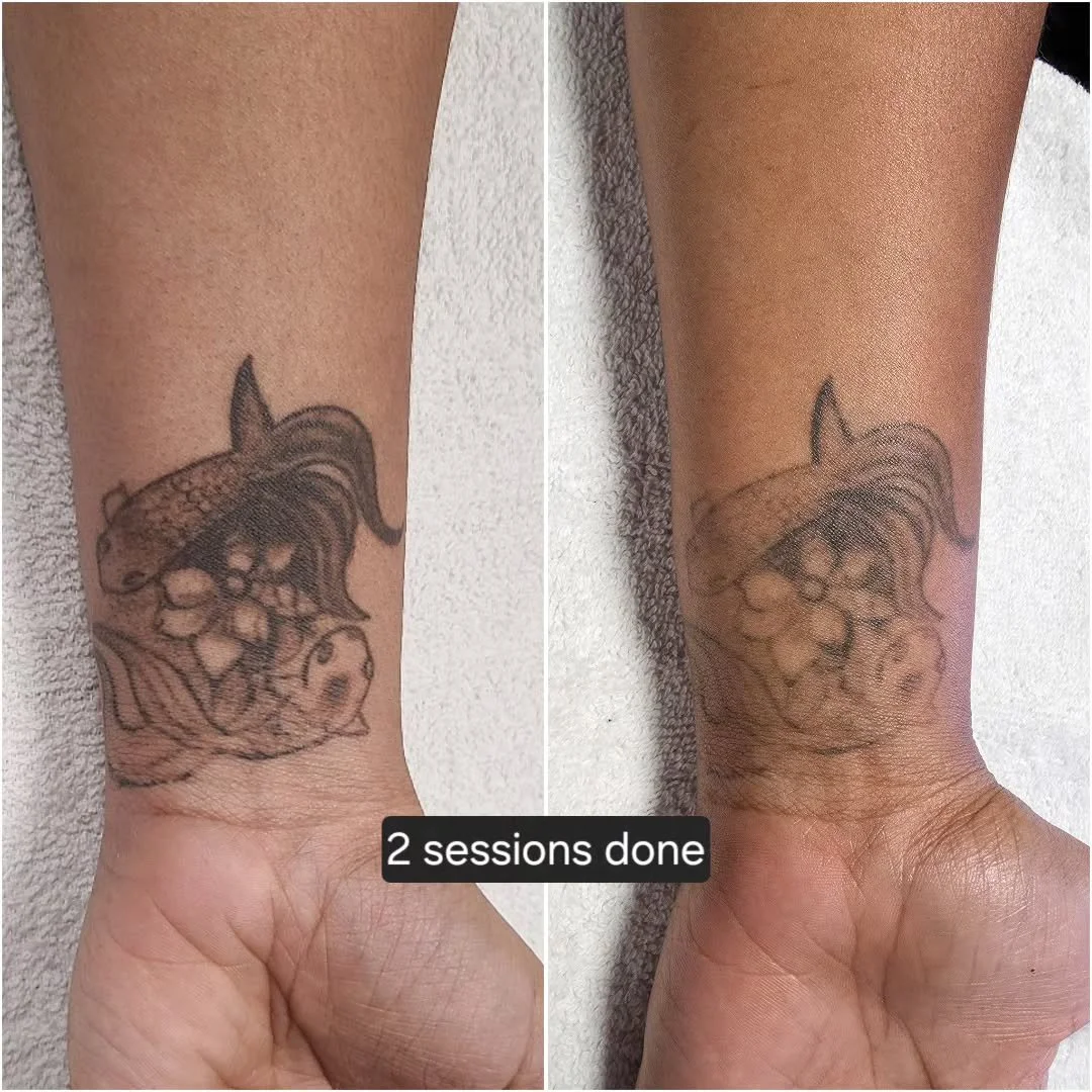 About a year between sessions, less is more. Everyone's body works differently, and results can vary depending on how strong a person's immune system is, the style/ink used, how healthy of a lifestyle a person lives...etc.

For any questions or inqui
