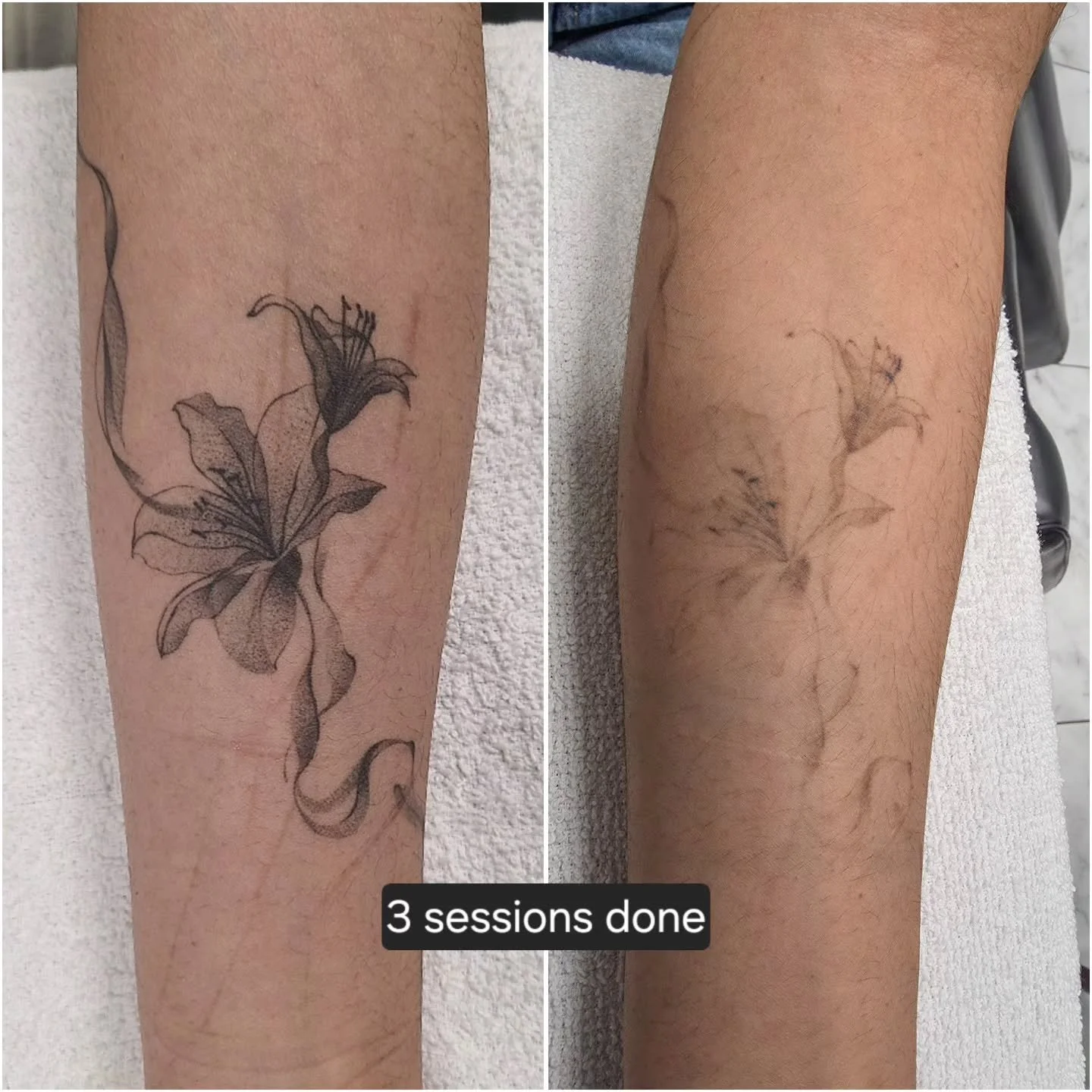 Everyone's body works differently, and results can vary depending on how strong a person's immune system is, the style/ink used, how healthy of a lifestyle a person lives...etc.

For any questions or inquiries free feel to DM. Thanks! 
.
.
.
. #laser