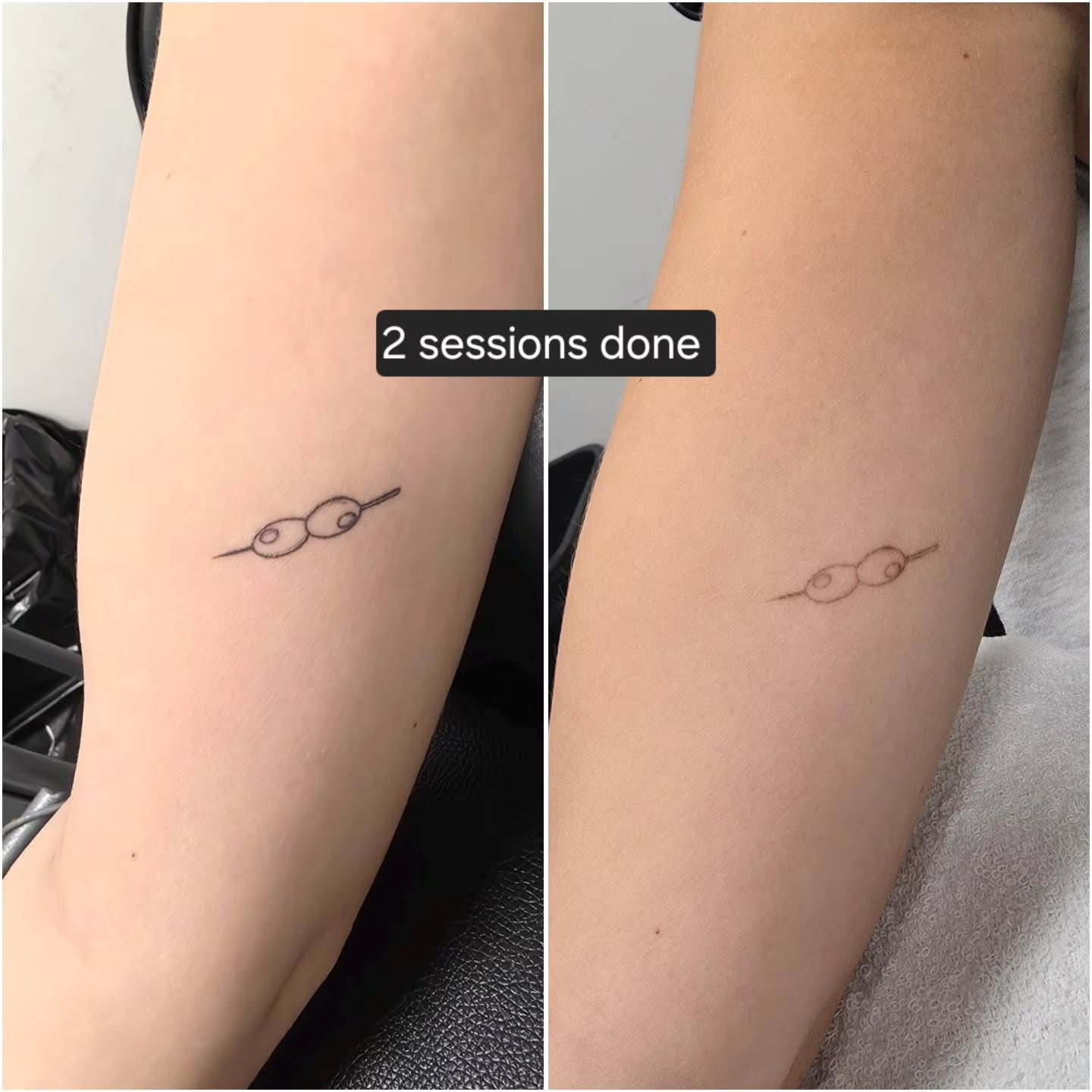 Everyone's body works differently, and results can vary depending on how strong a person's immune system is, the style/ink used, how healthy of a lifestyle a person lives...etc.

For any questions or inquiries free feel to DM. Thanks! 
.
.
.
. #laser