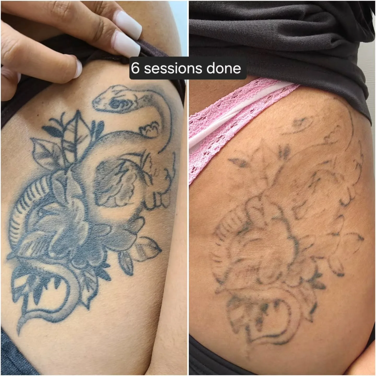 Everyone's body works differently, and results can vary depending on how strong a person's immune system is, the style/ink used, how healthy of a lifestyle a person lives...etc.

For any questions or inquiries free feel to DM. Thanks! 
.
.
.
. #laser