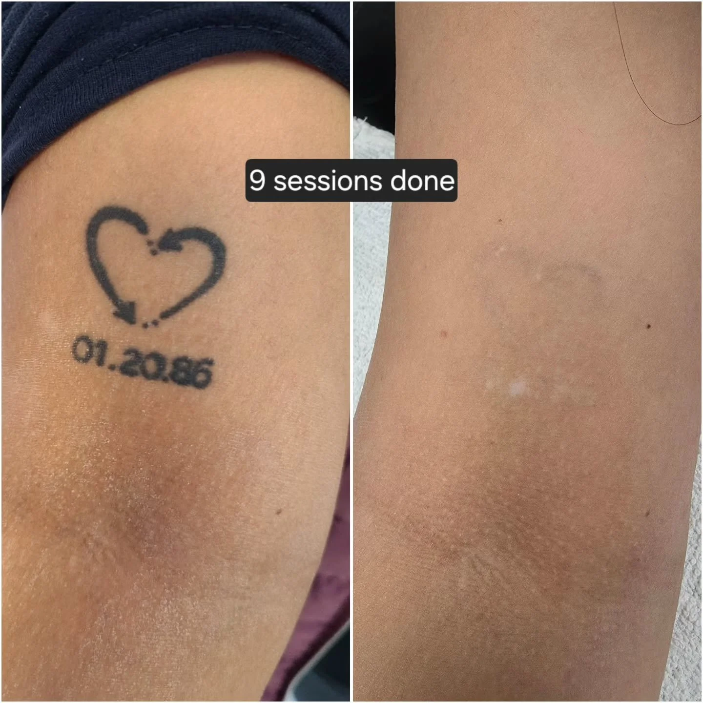 Everyone's body works differently, and results can vary depending on how strong a person's immune system is, the style/ink used, how healthy of a lifestyle a person lives...etc.

For any questions or inquiries free feel to DM. Thanks! 
.
.
.
. #laser