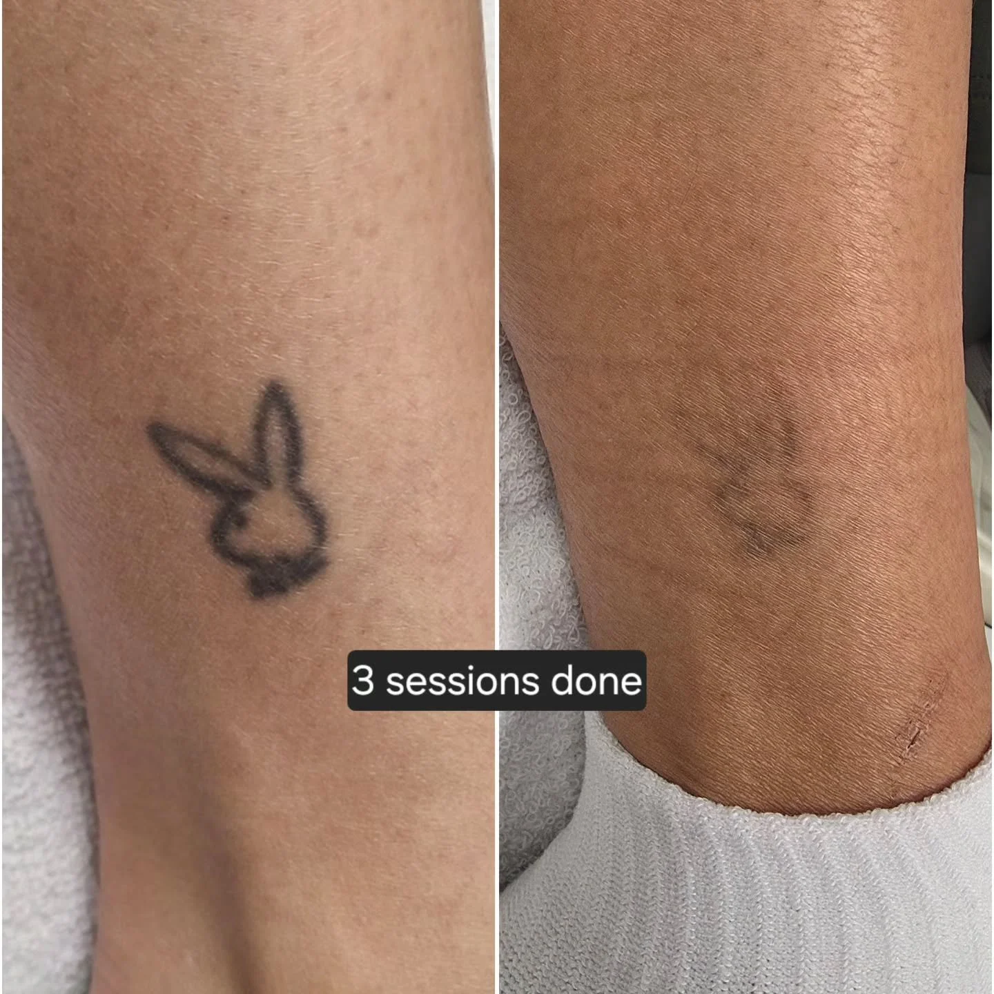 Everyone's body works differently, and results can vary depending on how strong a person's immune system is, the style/ink used, how healthy of a lifestyle a person lives...etc. the average tattoo can take 8-12 sessions to remove. 

For any questions