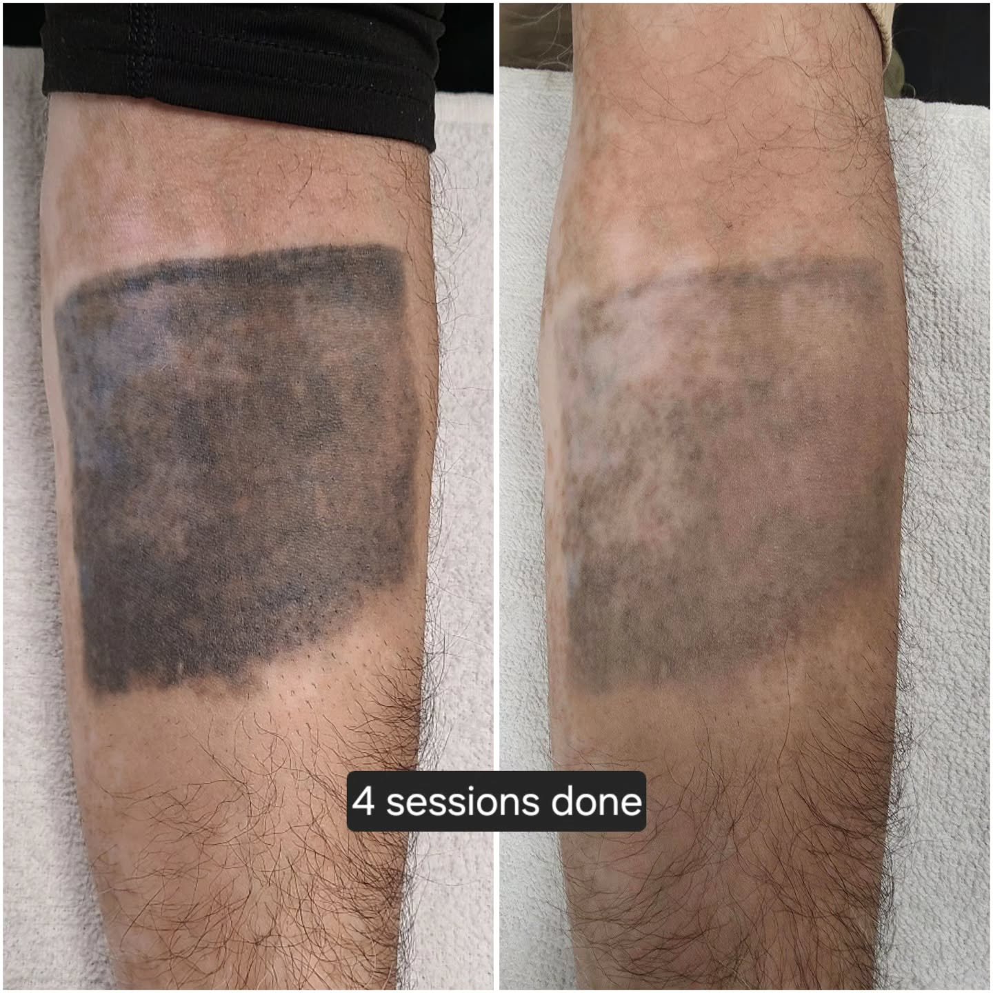 Everyone's body works differently, and results can vary depending on how strong a person's immune system is, the style/ink used, how healthy of a lifestyle a person lives...etc. the average tattoo can take 8-12 sessions to remove. 

For any questions